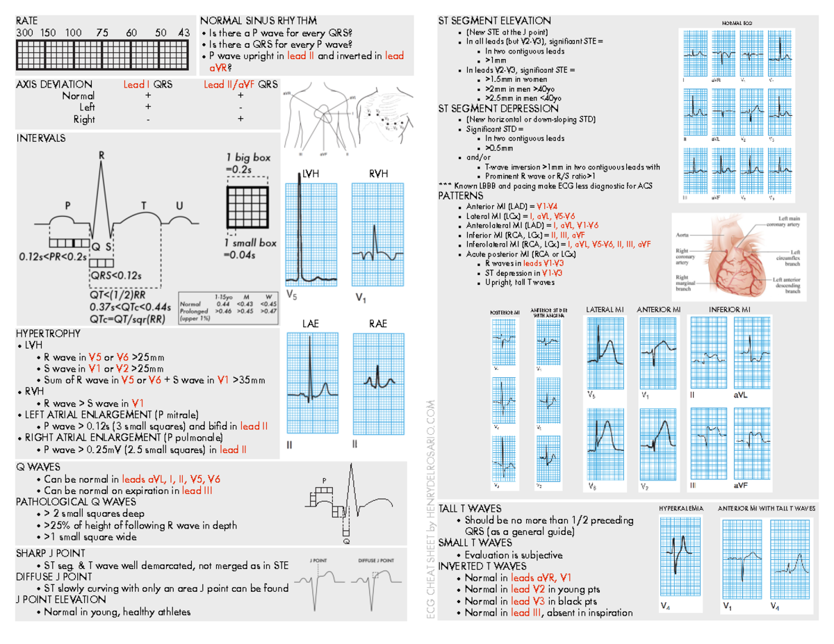 Ecg Cheat Sheet 35 9 Pdf Free - Hypertrophy • Lvh R Wave In V5 Or V6 