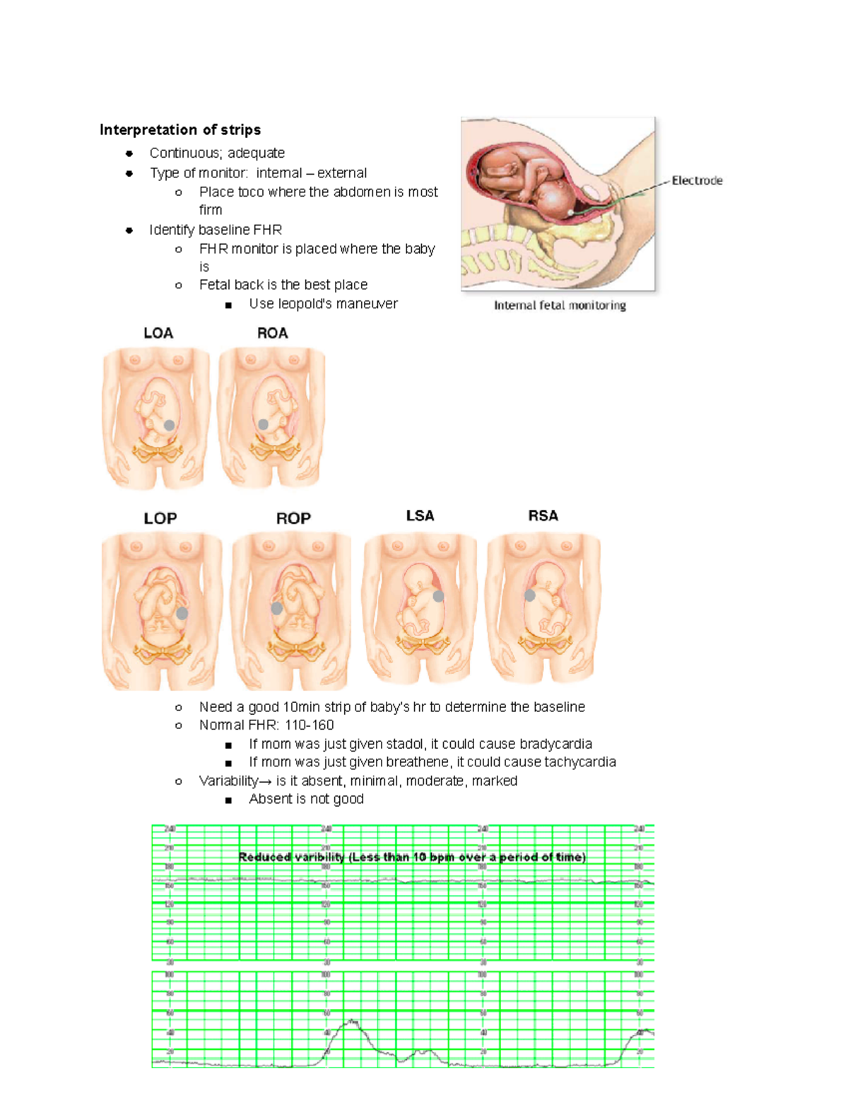 Fetal heart rate monitoring - Interpretation of strips Continuous ...