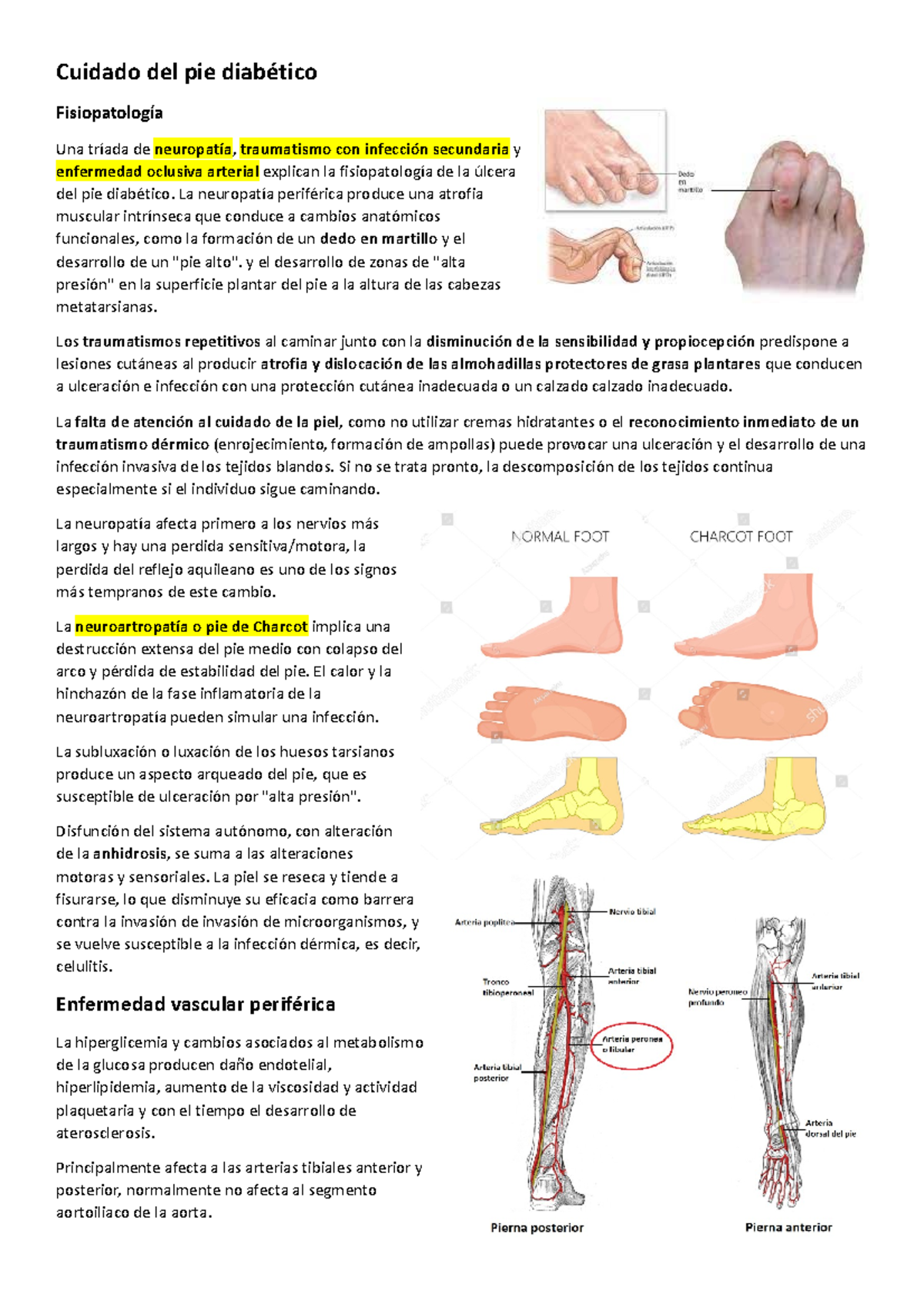 Pie diabetico Resumen sobre el pie diabético producto de una
