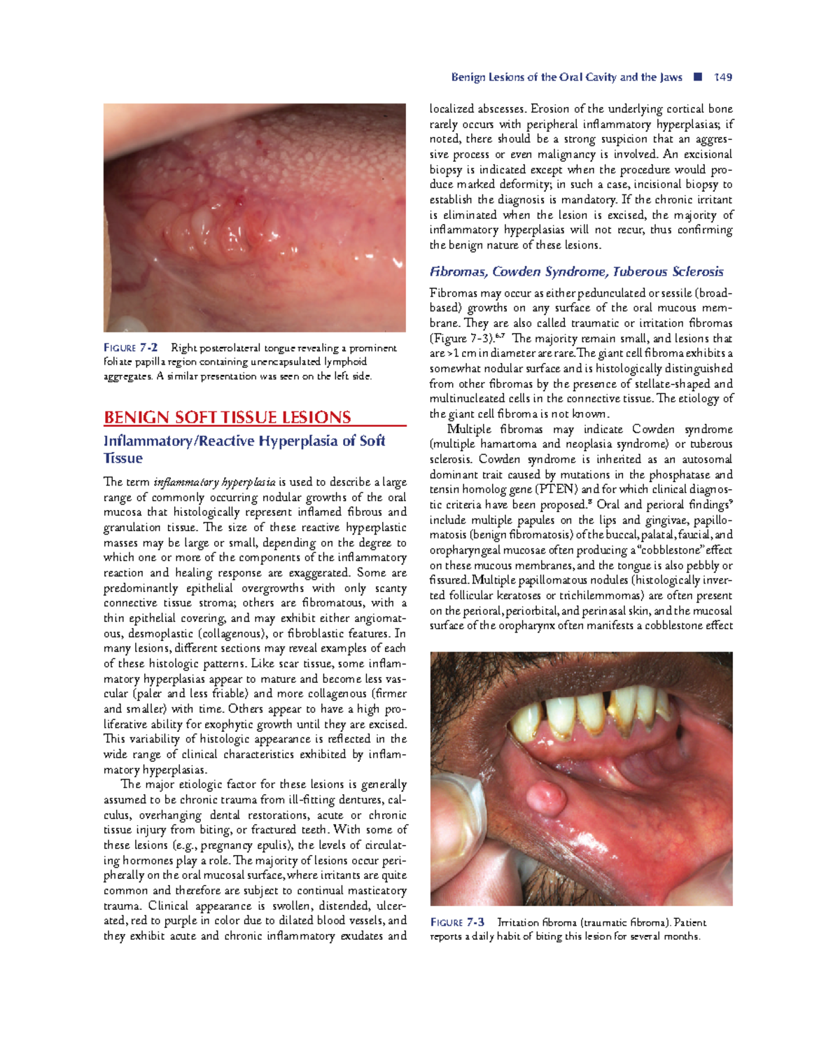 Burkets Oral Medicine compressed subset 12 - Benign Lesions of the Oral ...