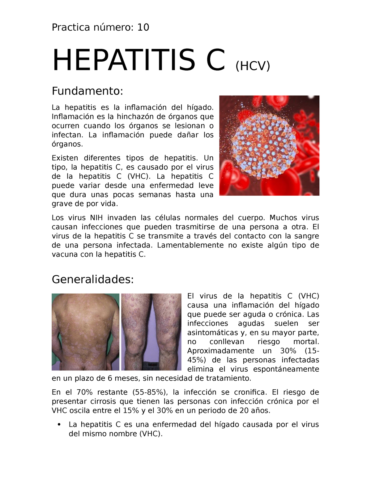 Hepatitis C HEPATITIS C HCV Fundamento La hepatitis es la inflamación del hígado