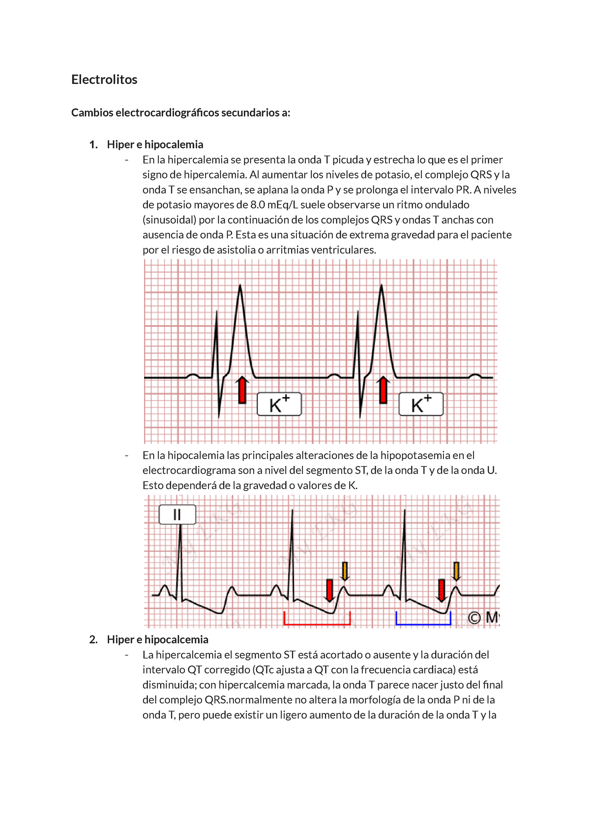 electrocardiograma de hipercalcemia