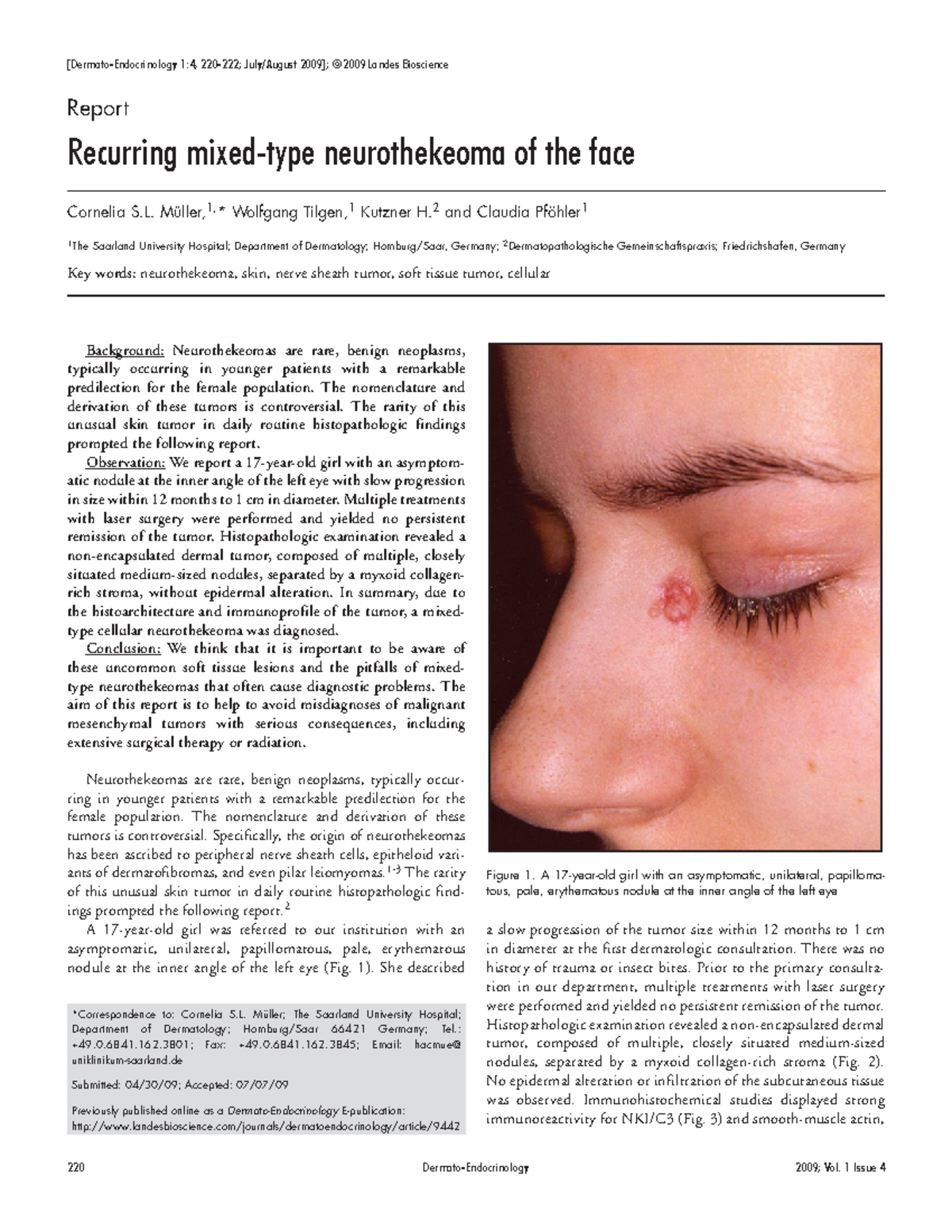 Recurring mixed-type neurothekeoma of the face - [Dermato-Endocrinology ...