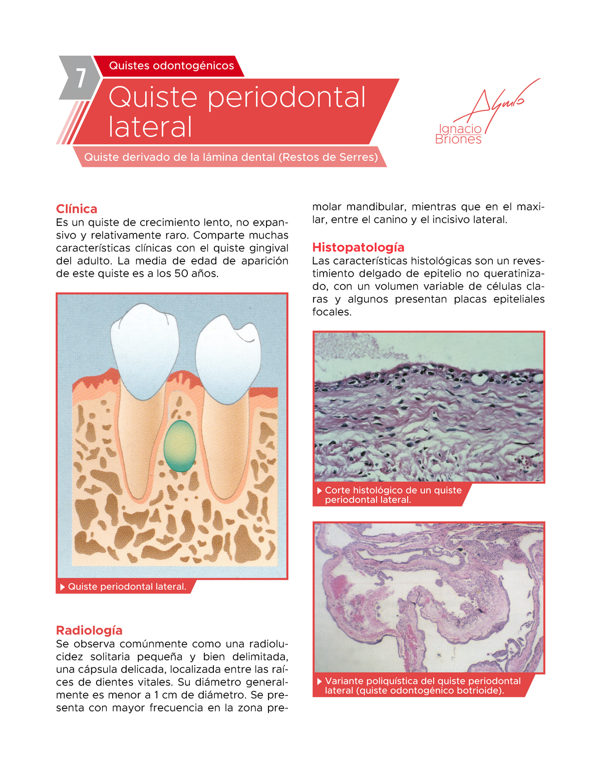 Quiste Periodontal Lateral Patología oral e histología