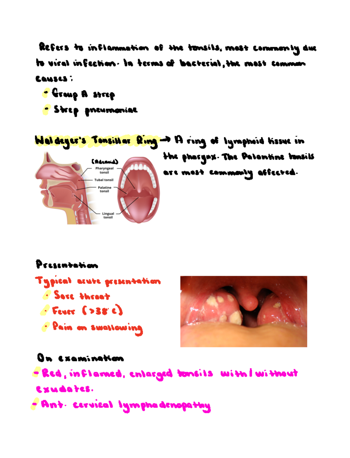 Tonsillitis Refers To Inflammation Of The Tonsils Most Commonly Due