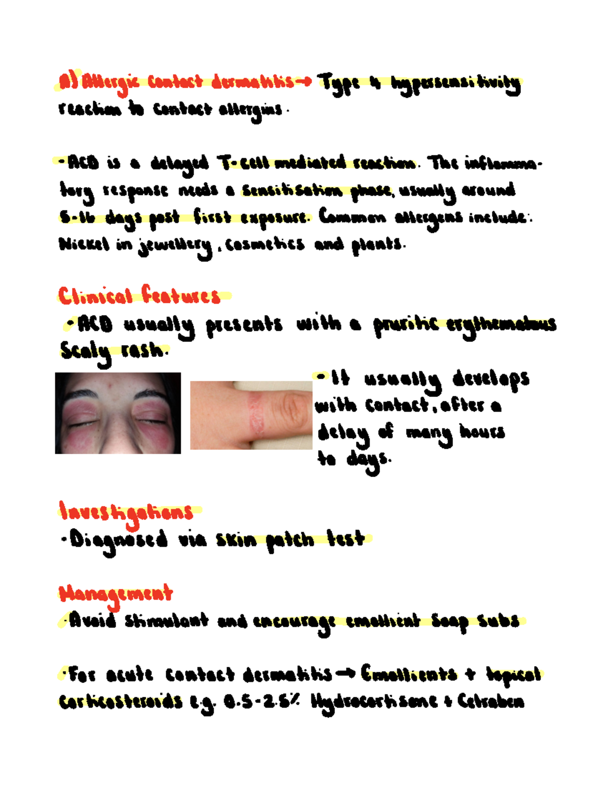 Dermatitis (eczema) - A Allergic contact dermatitis Type 4 ...