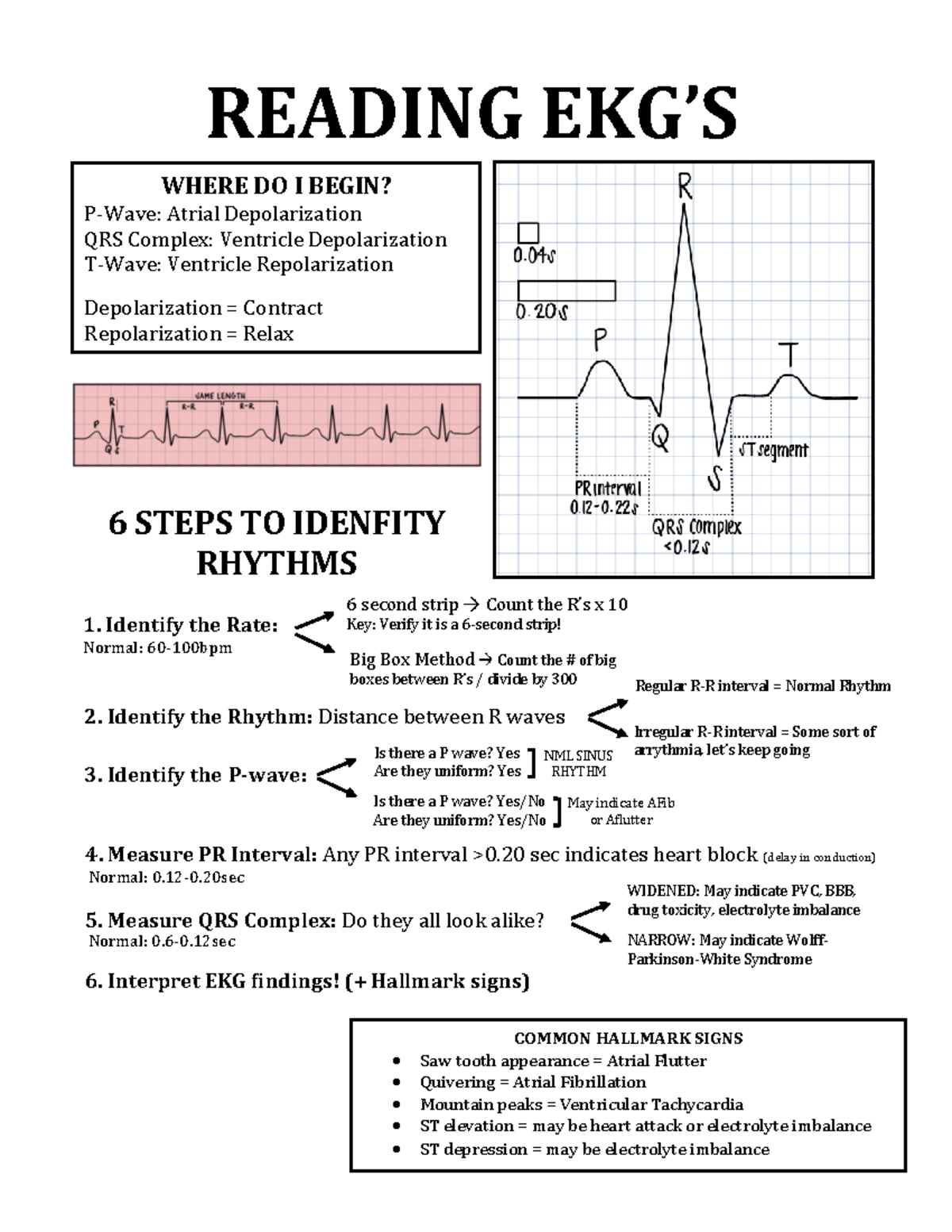 Reading EKG's help NML SINUS RHYTHM Irregular RR interval = Some