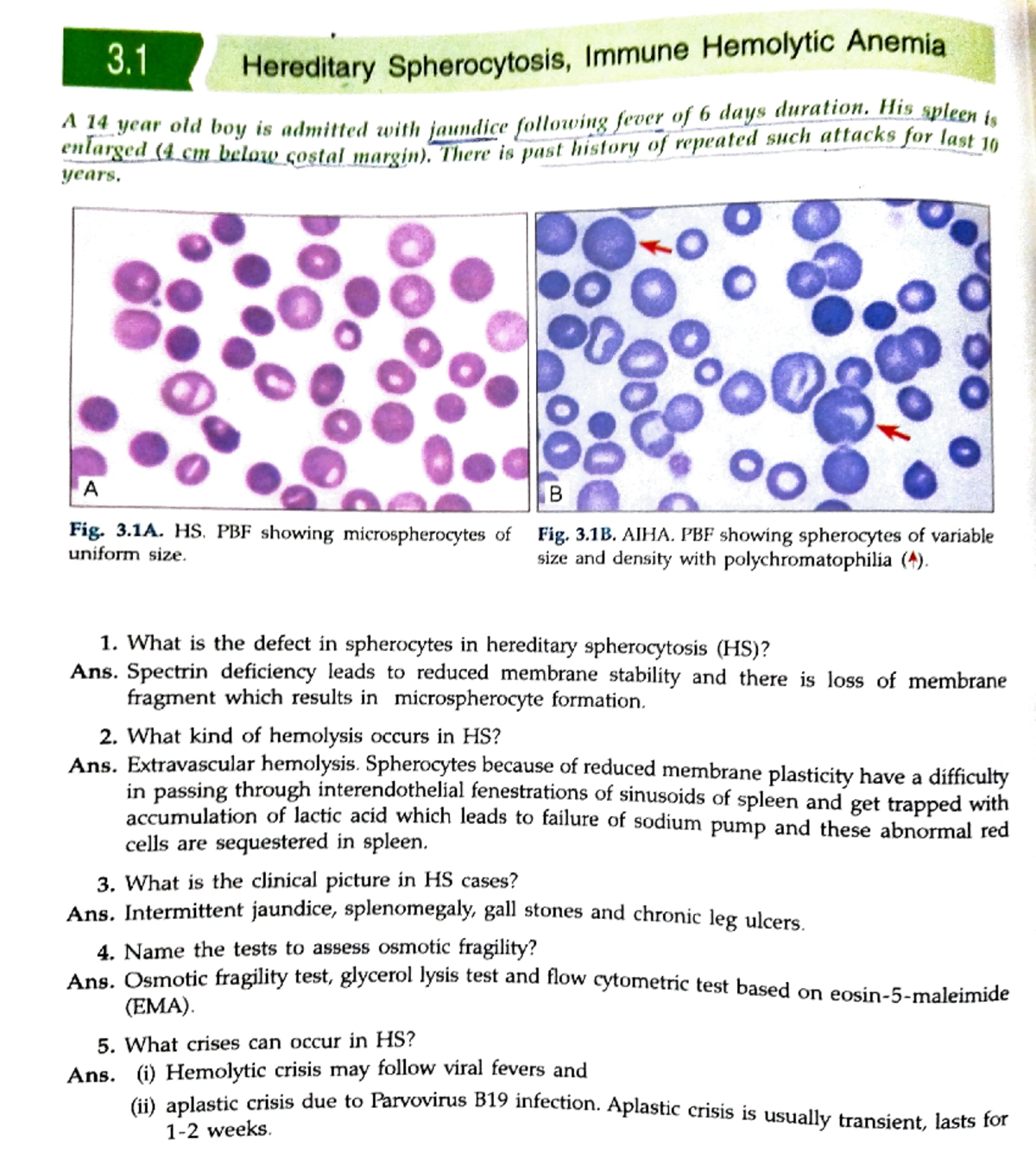 Adobe Scan 23-Oct-2022 - 3. Hereditary Spherocytosis, Immune Hemolytic ...