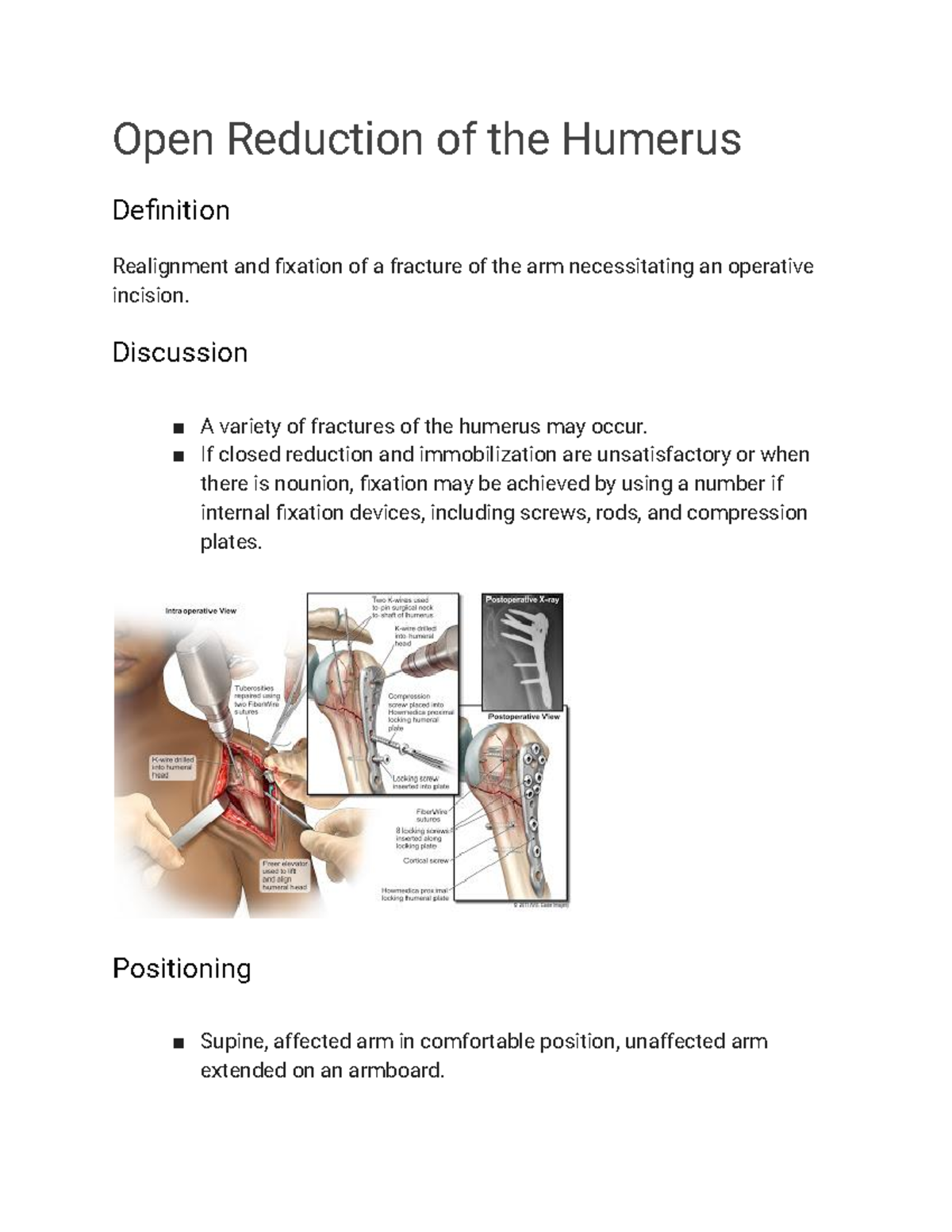 open-reduction-of-the-humerus-open-reduction-of-the-humerus