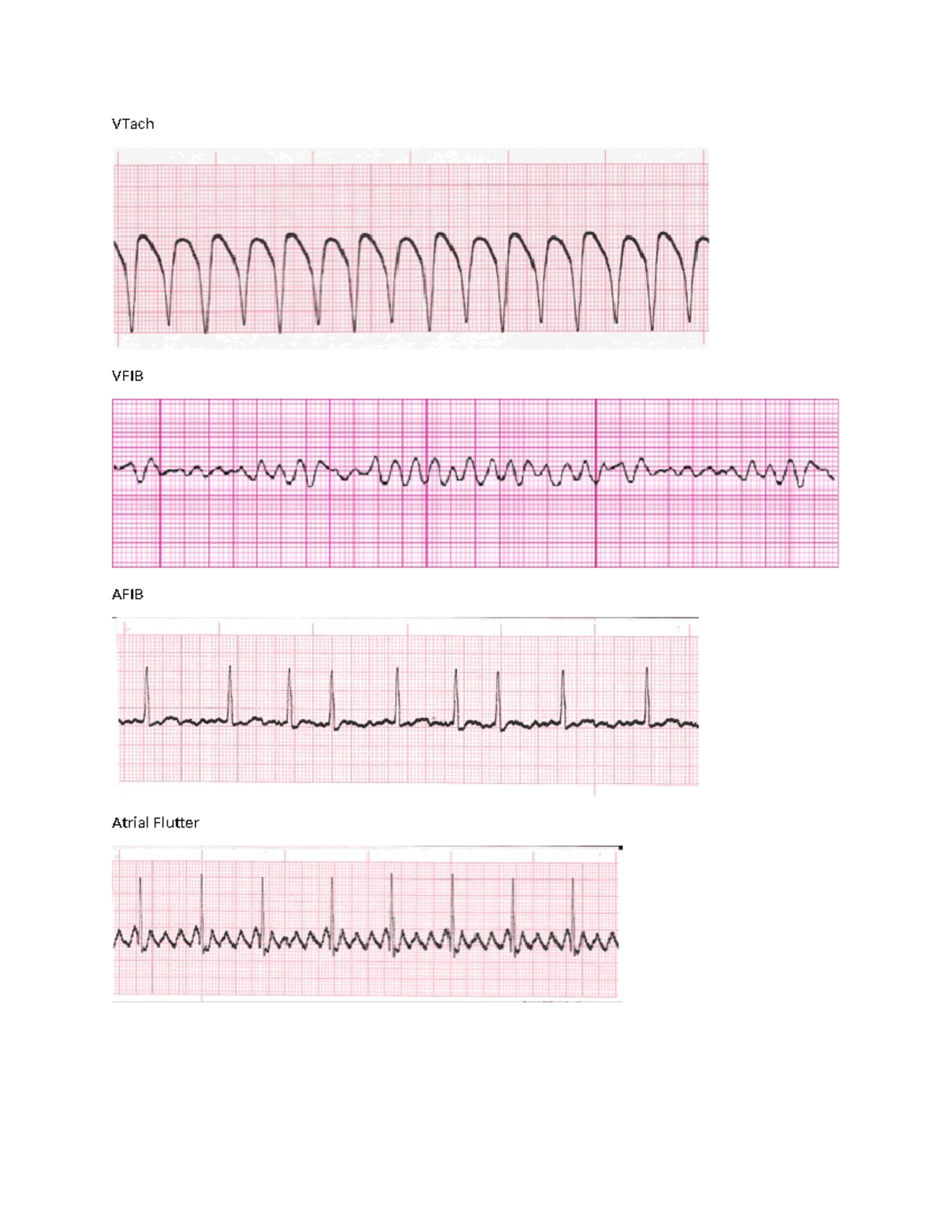 Cardiac+Rhythm+strips+N102 - NURS220 - VTach VFIB AFIB Atrial Flutter ...