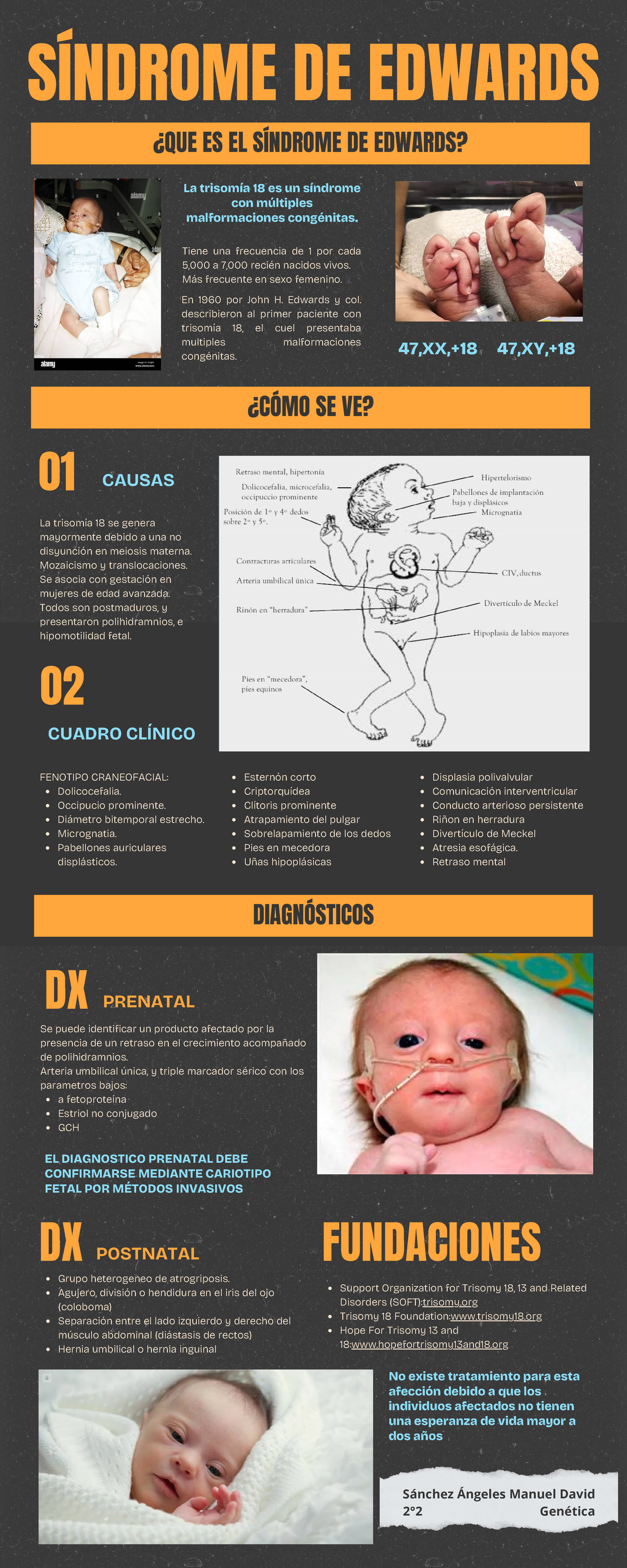 Sindrome de Edwards - Gnentica - SÍNDROME DE EDWARDS ¿QUE ES EL ...