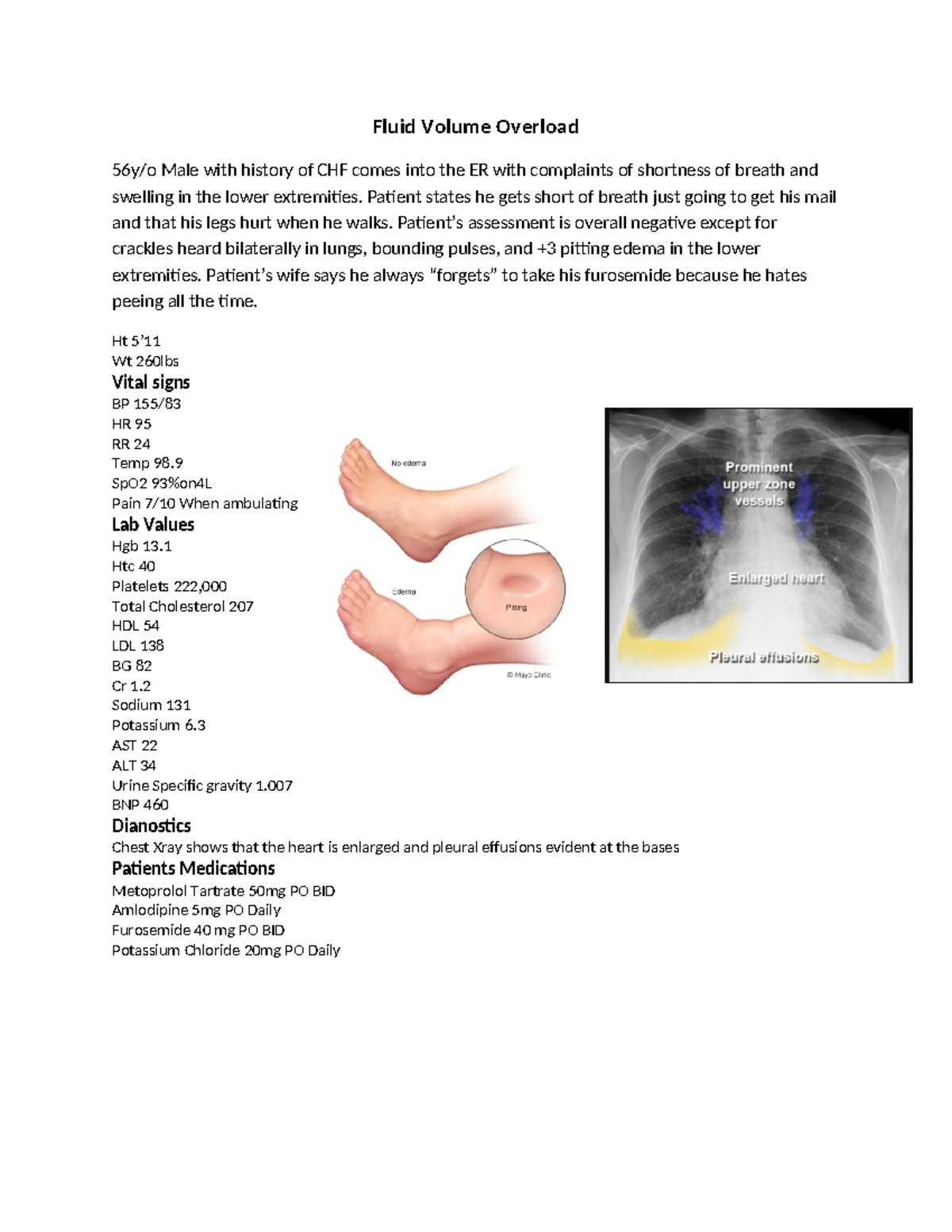 Fluid Volume Overload Case Study - Fluid Volume Overload 56y/o Male ...