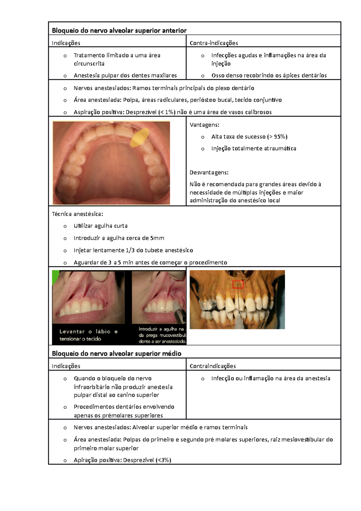 Bloqueio Do Nervo Alveolar Superior Anterior Bloqueio Do Nervo Alveolar Superior Anterior