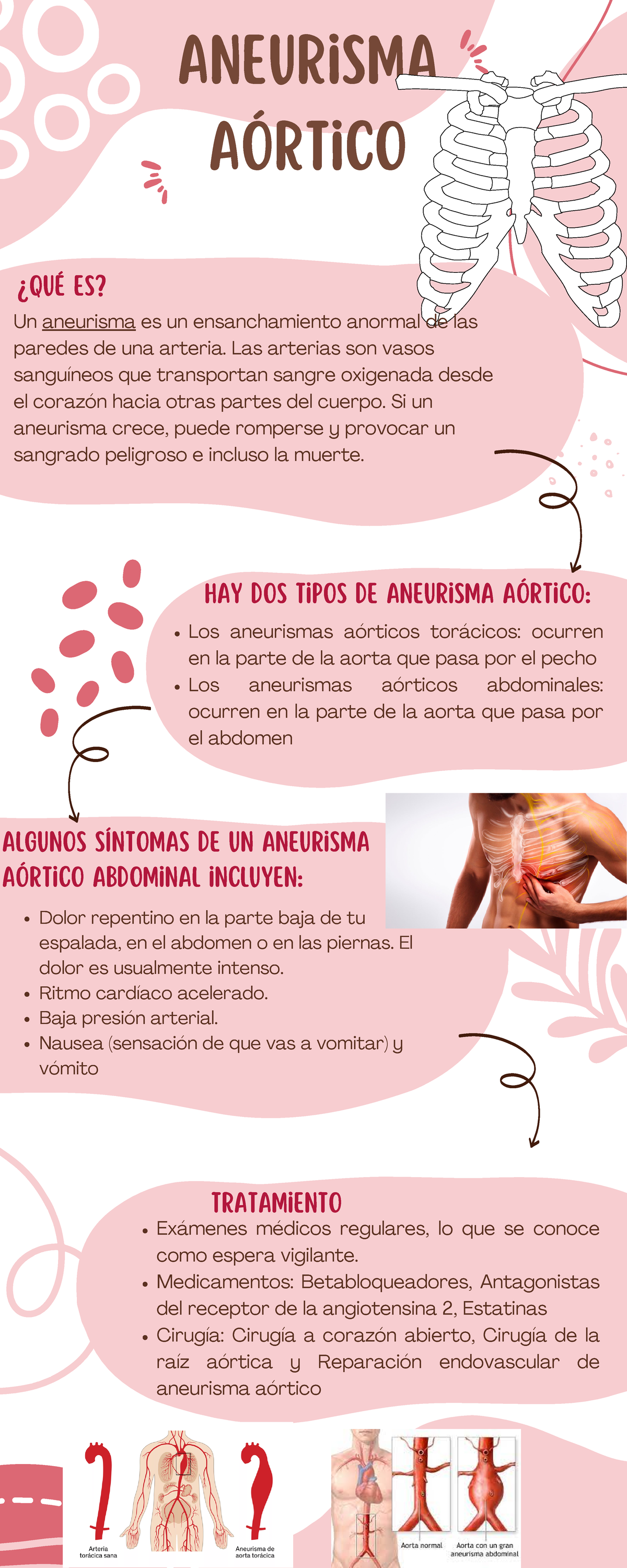 Aneurismo - Apuntes de la semana del 23 al 27 de noviembre - Aneurisma ...