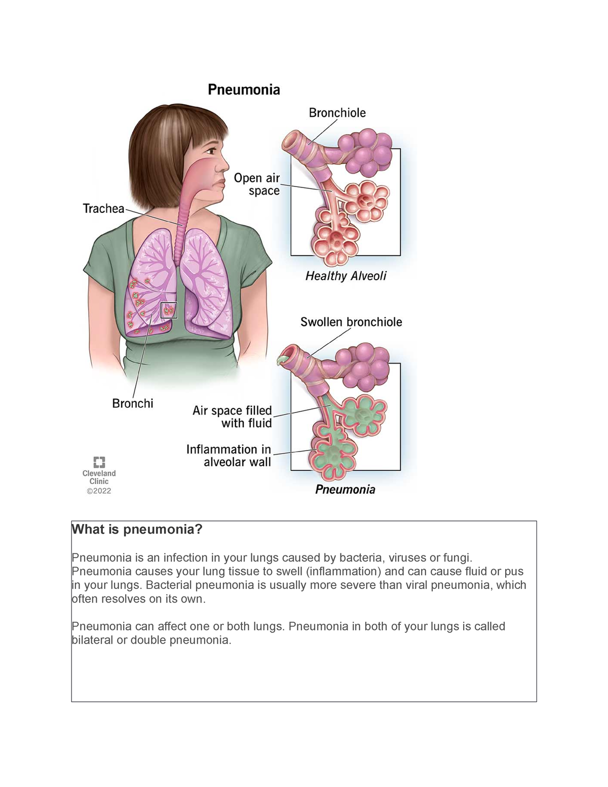 Pneumonia - What is pneumonia? Pneumonia is an infection in your lungs ...