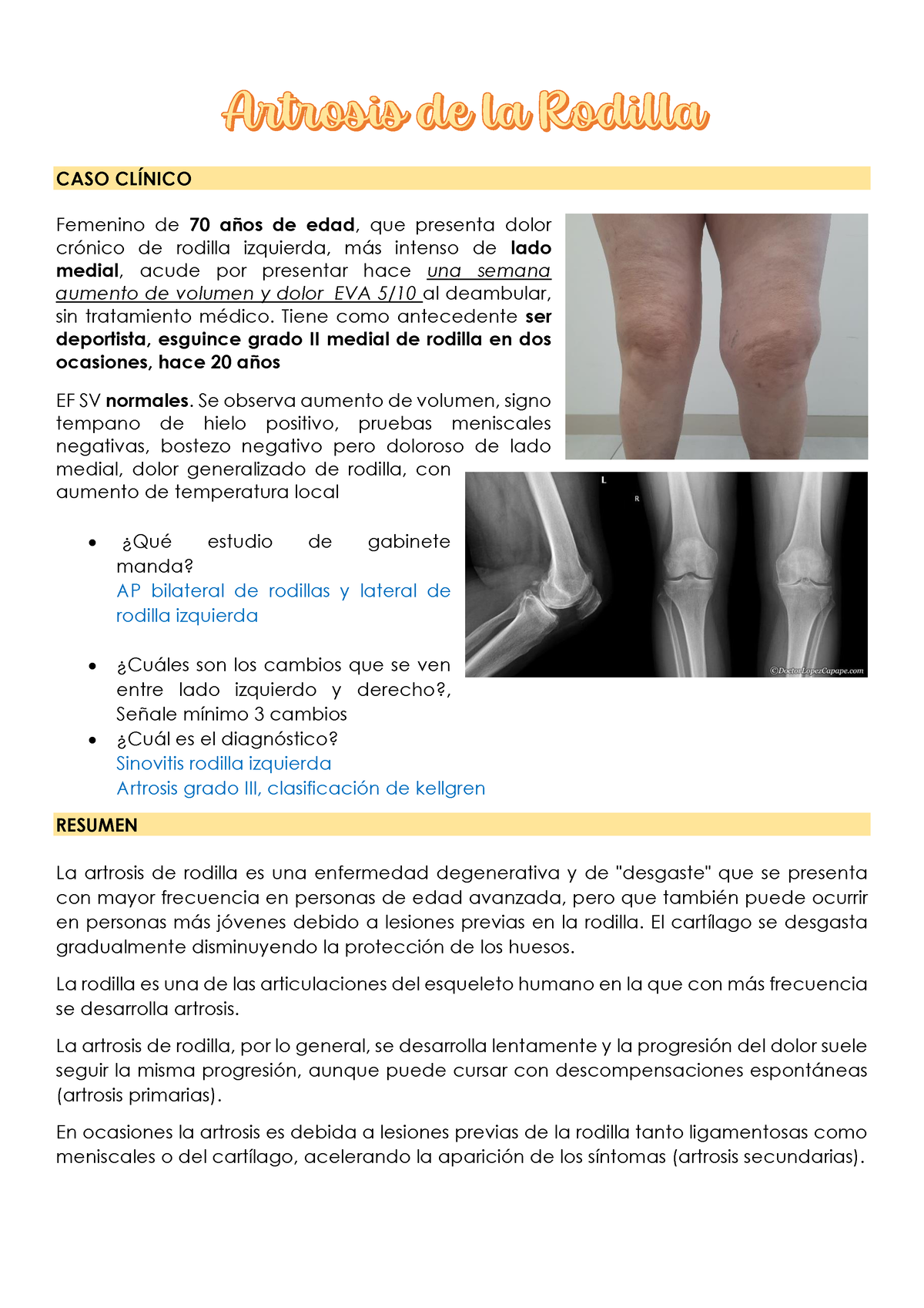 Caso Clínico: Artrosis de rodilla con varo severo que requiere dispositivos  especiales - Surbone