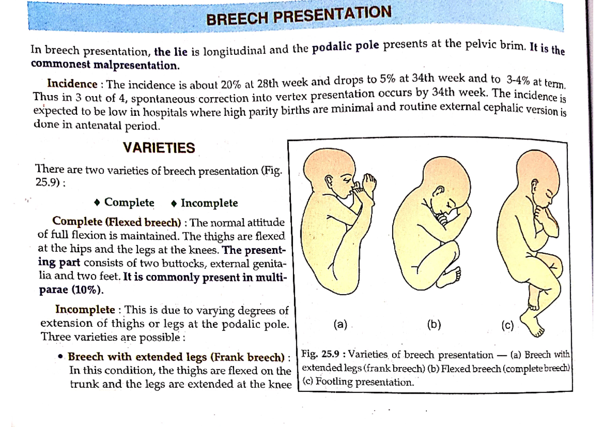 breech presentation in 20 weeks