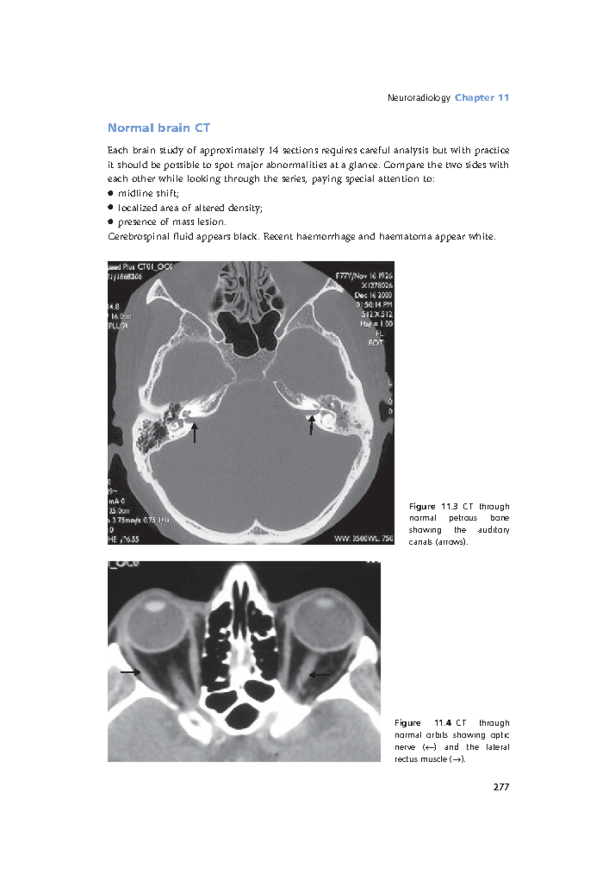 Radiology Lecture Notes pdf (93) Neuroradiology Chapter 11 277 Figure