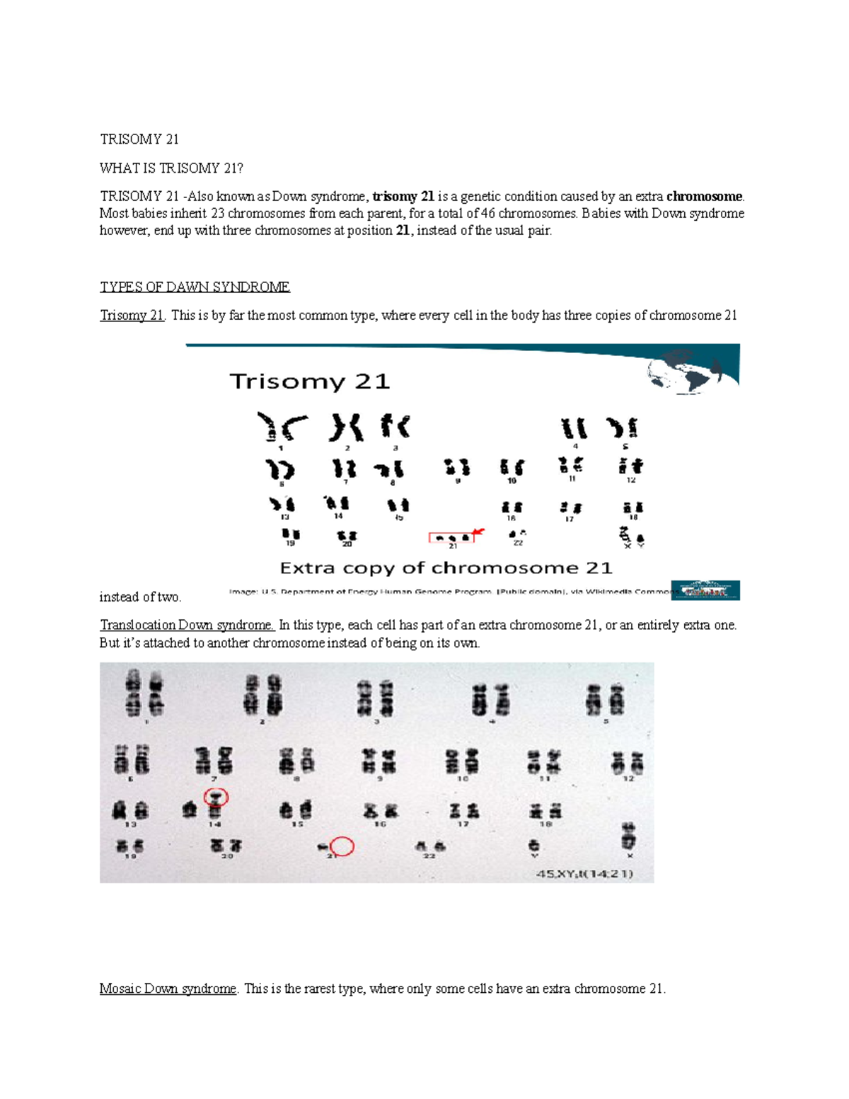 trisomy-21-vinarao-eugene-trisomy-21-what-is-trisomy-21-trisomy