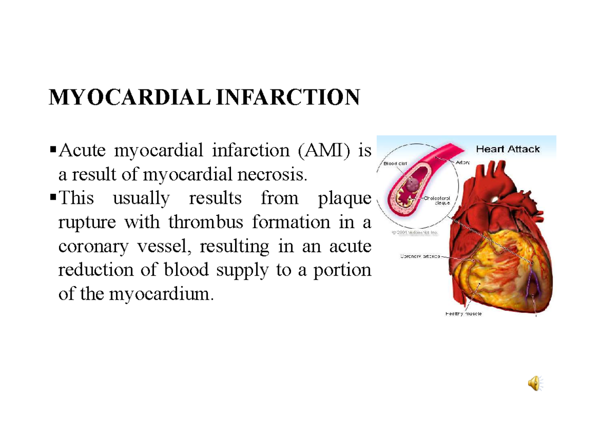 Lec4. D Raed Ismail Myocardial infarction - MYOCARDIAL INFARCTION Acute ...