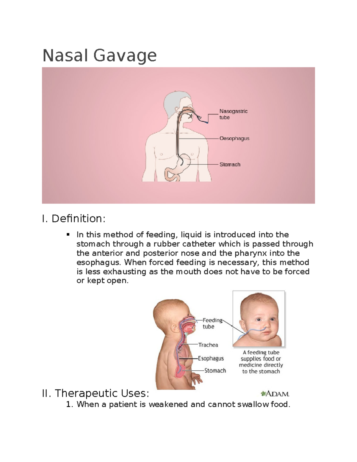Nasal Gavage Definition In this method of feeding, liquid is