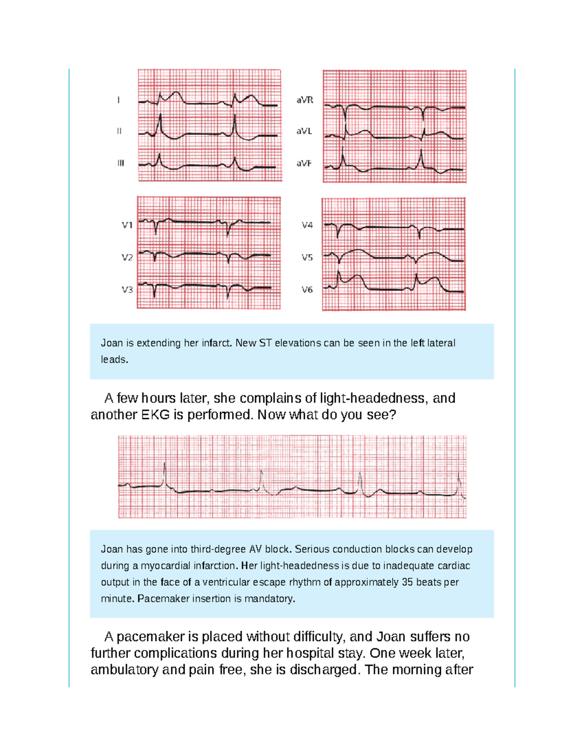 The only EKG-97 - The only EKG - Joan is extending her infarct. New ST ...