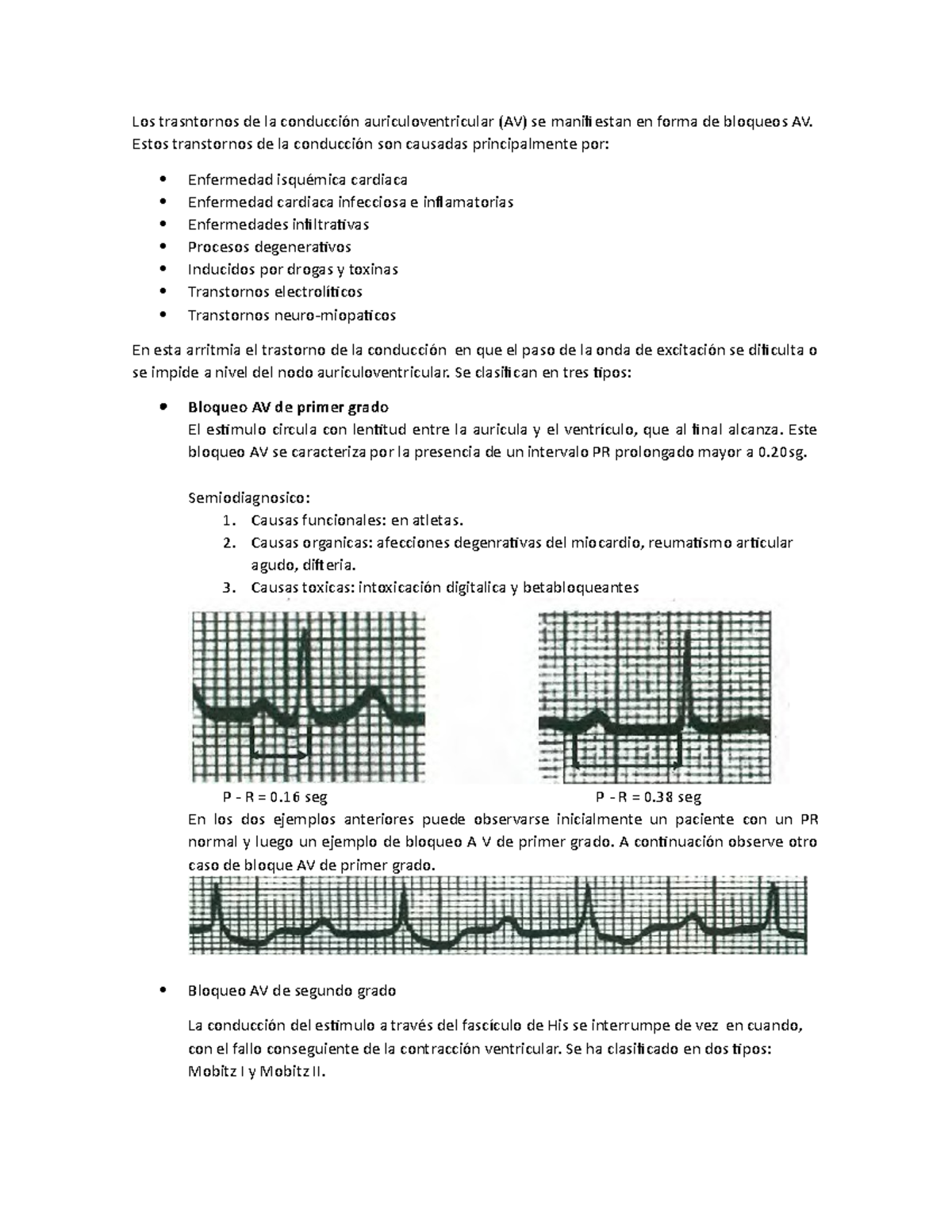 Bloqueos auriculoventriculares Los trasntornos de la conducción auriculoventricular (AV) se Bloqueos auriculoventriculares Los trasntornos de la conducción auriculoventricular (AV) se