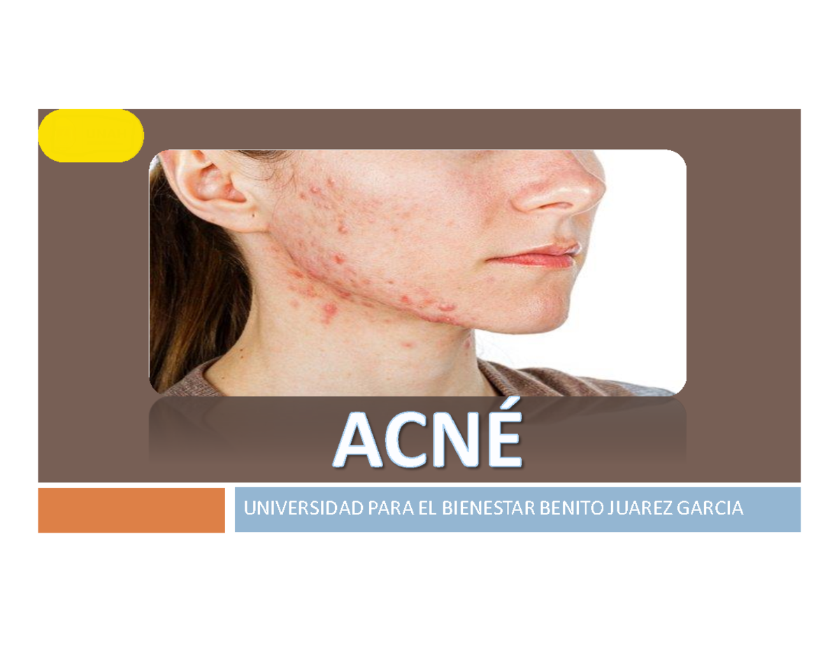 Acne edited - ACNÉ UNIVERSIDAD PARA EL BIENESTAR BENITO JUAREZ GARCIA ...