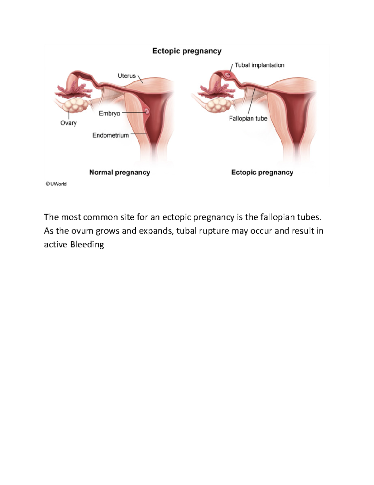 Uworld Todos LOS Cuadros - The most common site for an ectopic ...