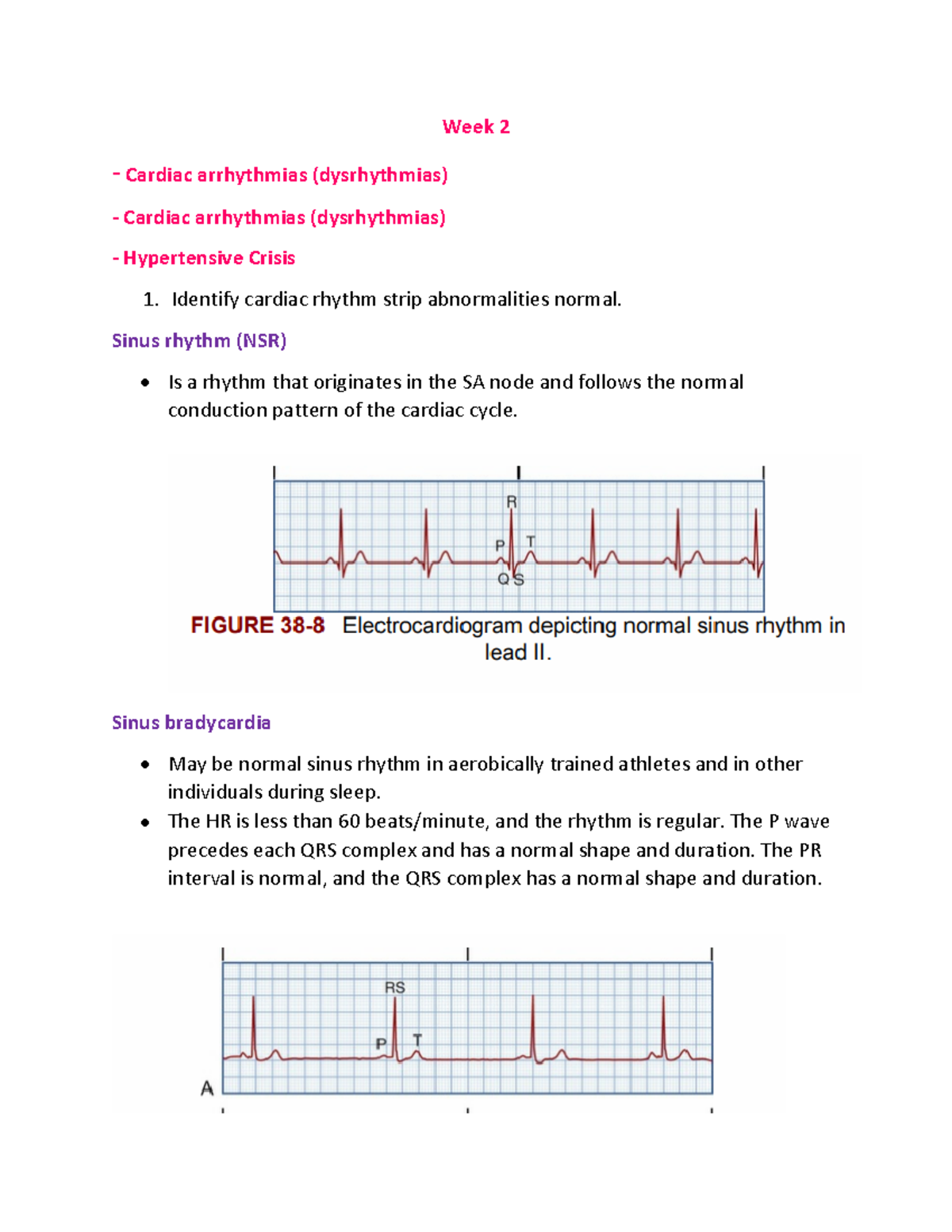 Week 2- lecture notes - Week 2 - Cardiac arrhythmias (dysrhythmias ...