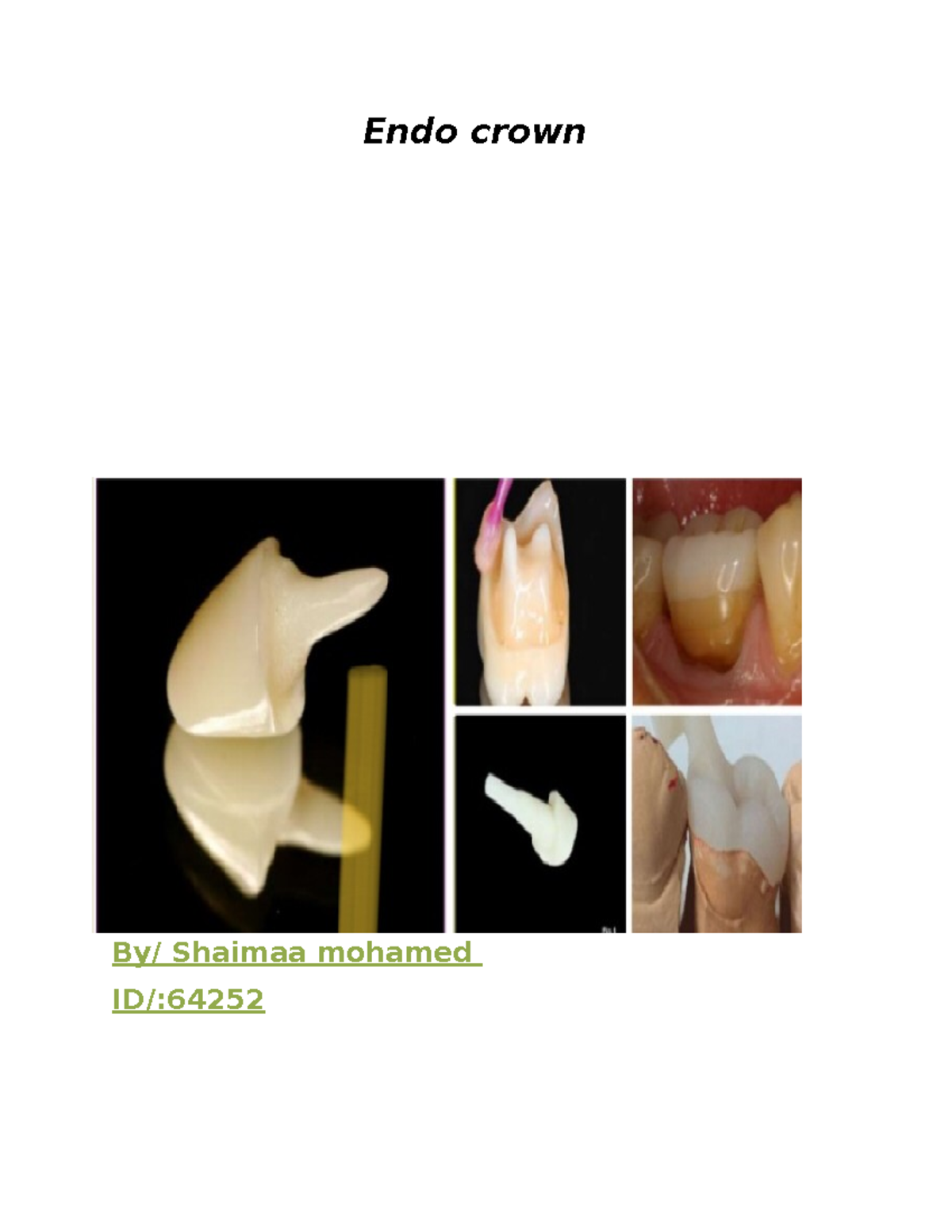 Copy of Endo crown Endo crown By/ Shaimaa mohamed ID/ Definition The