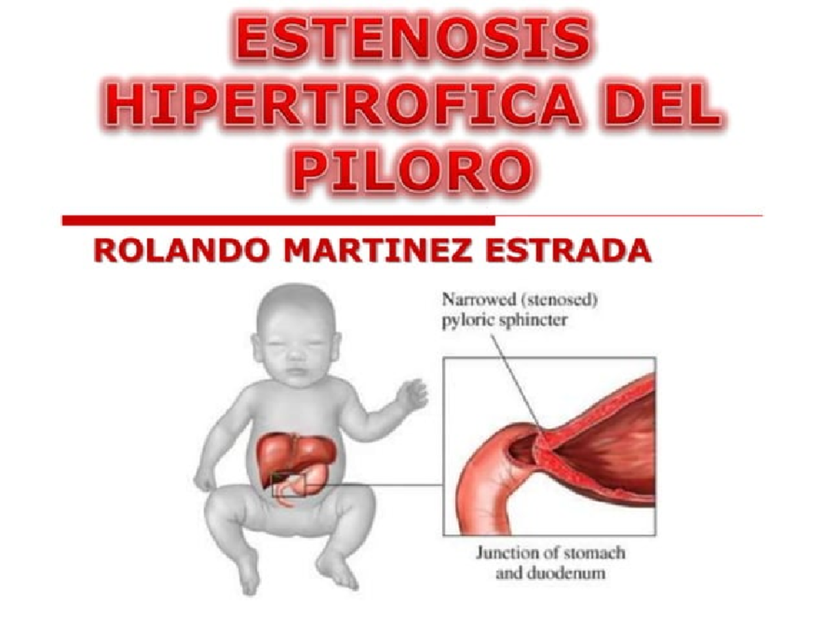 Estenosis-hipertrofica-del-piloro-5219230 240904 162145 - ESTENOSIS