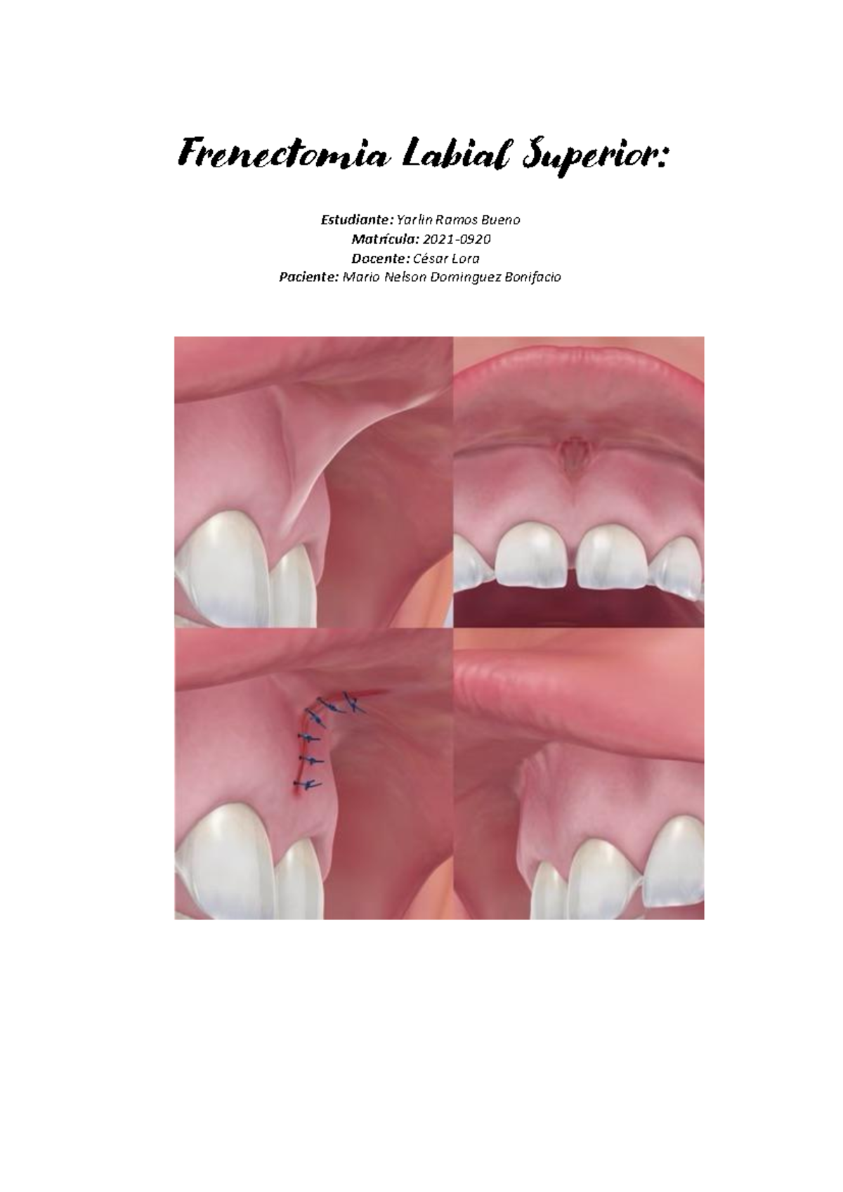 Frenectomia labial protocolo - Frenectomia Labial Superior: Estudiante ...