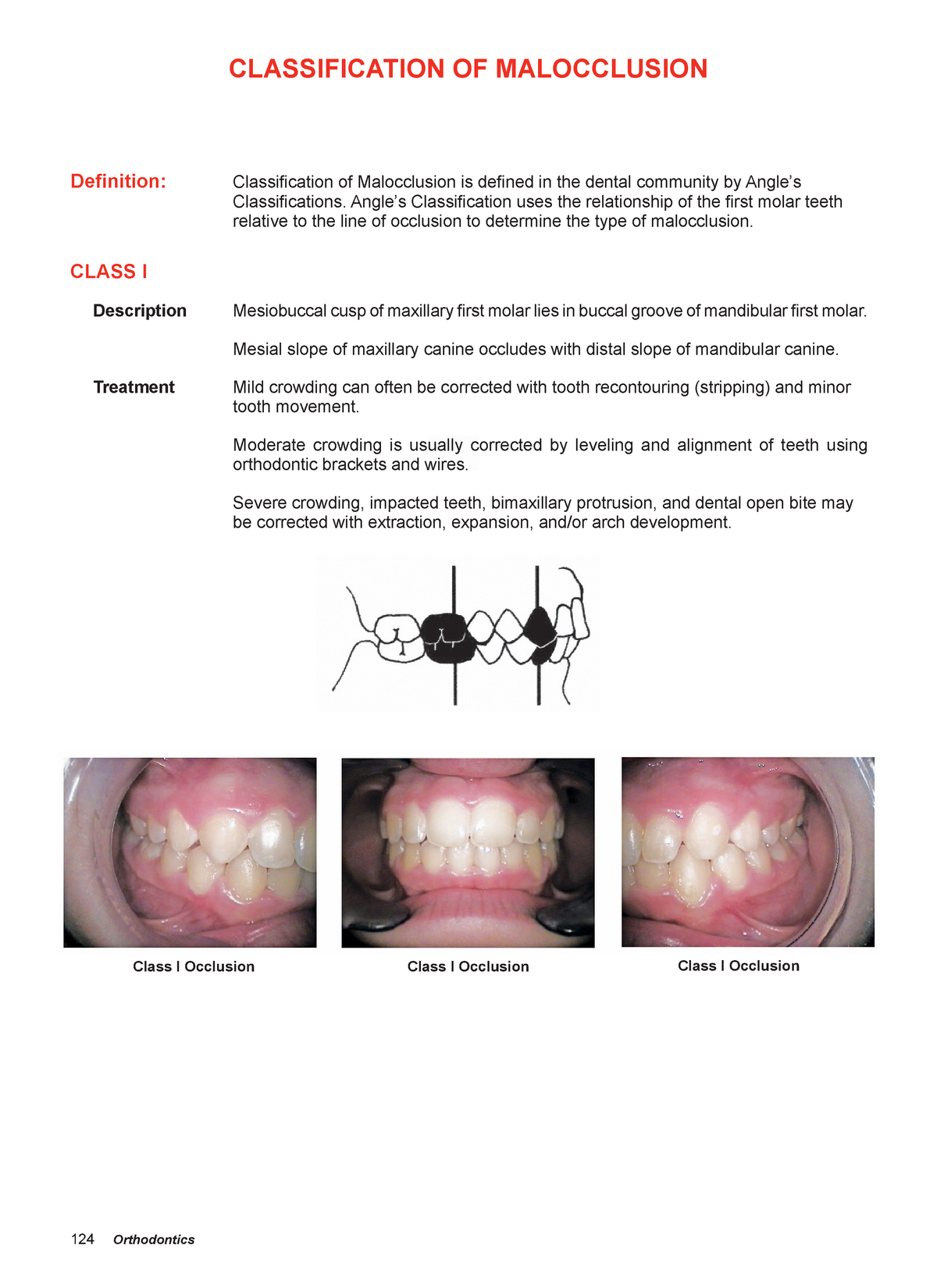 Ihcd 13 Ihcd 124 Orthodontics Classification Of Malocclusion Class