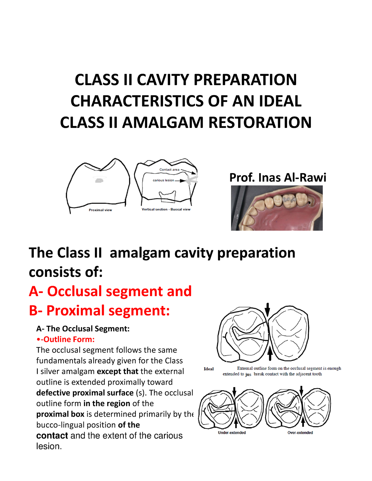 Class II Cavity Preparation Characteristics OF AN Ideal Class II ...