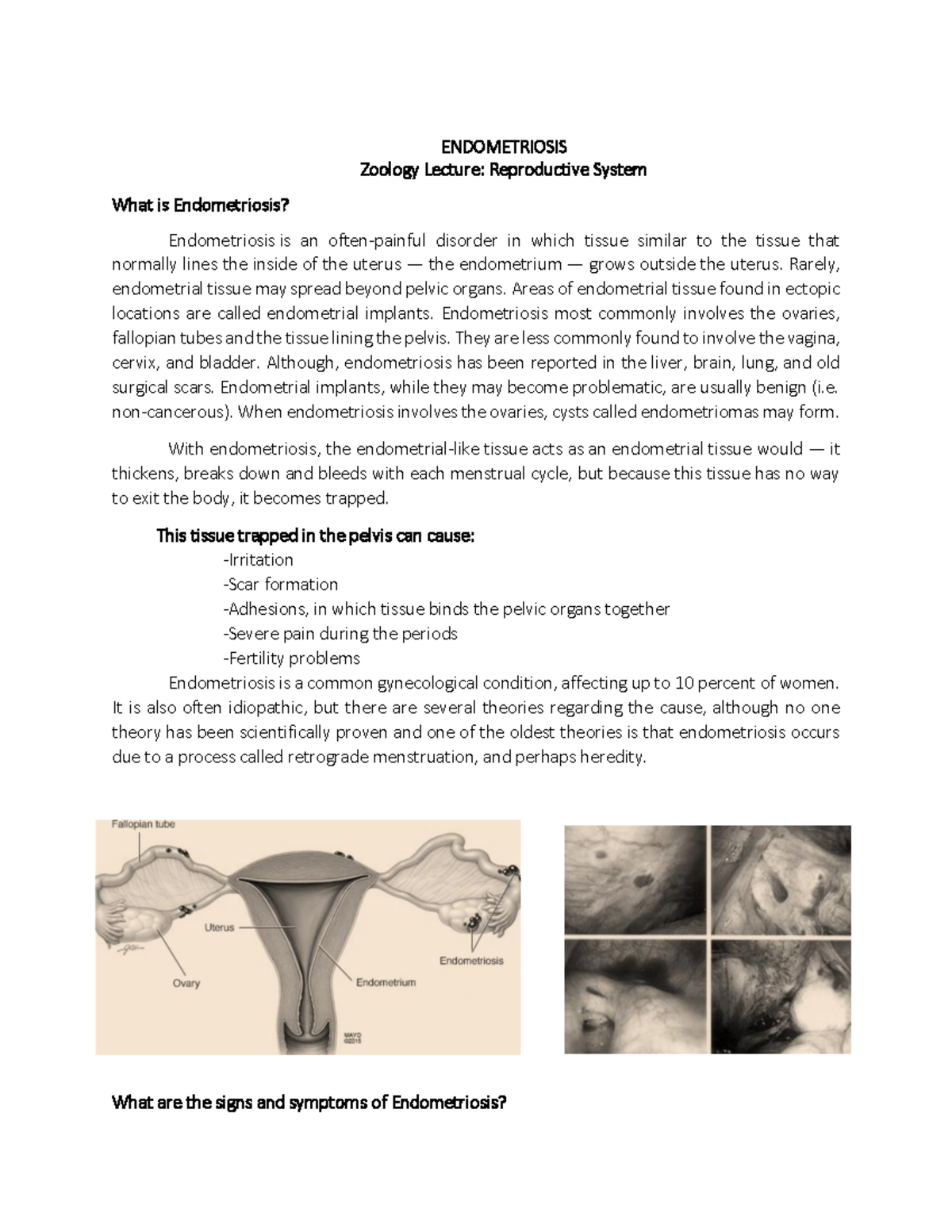 Reproductive System- 2 diseases - ENDOMETRIOSIS Zoology Lecture ...