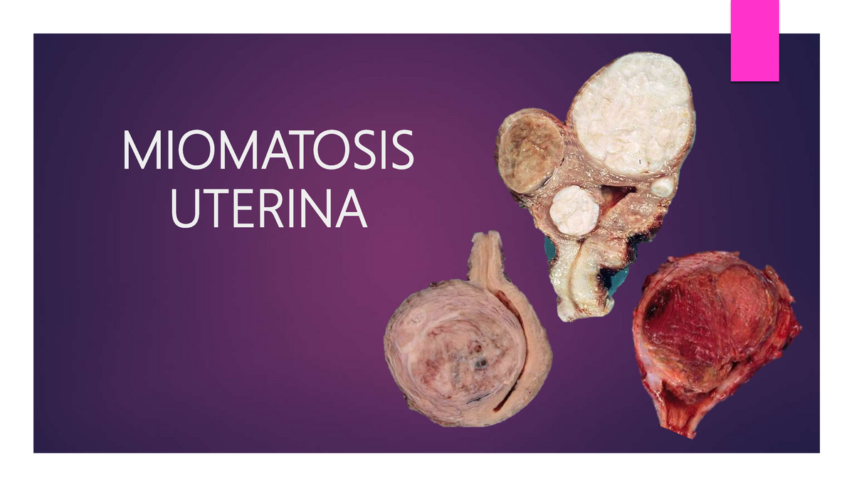 Miomatosis Uterina Miomatosis Uterina Miomas Uterinos Son Neoplasias Benignas Compuestas De 1749