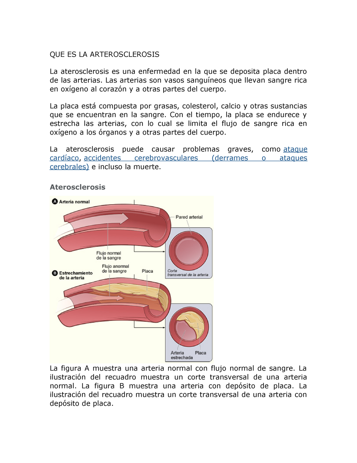 muestra de placa de aterosclerosis