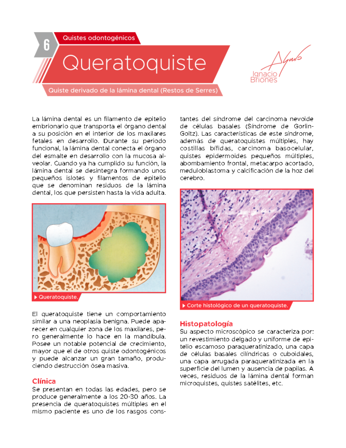 Queratoquiste odontogénico La lámina dental es un filamento de epitelio embrionario que Queratoquiste odontogénico La lámina dental es un filamento de epitelio embrionario que