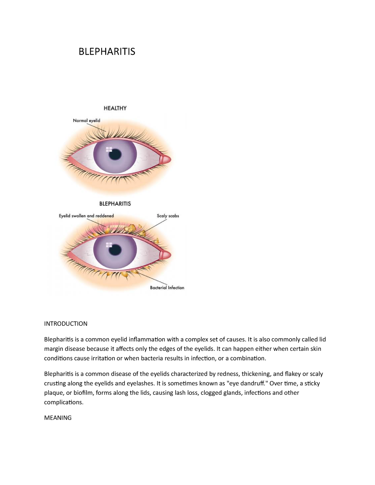 Blepharitis Wps Office Blepharitis Introduction Blepharitis Is A