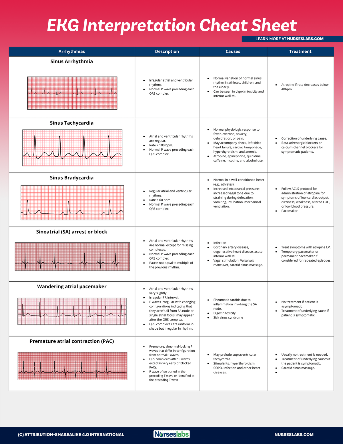 EKG interpretation - worksheet - Sinus Bradycardia Regular atrial and ...