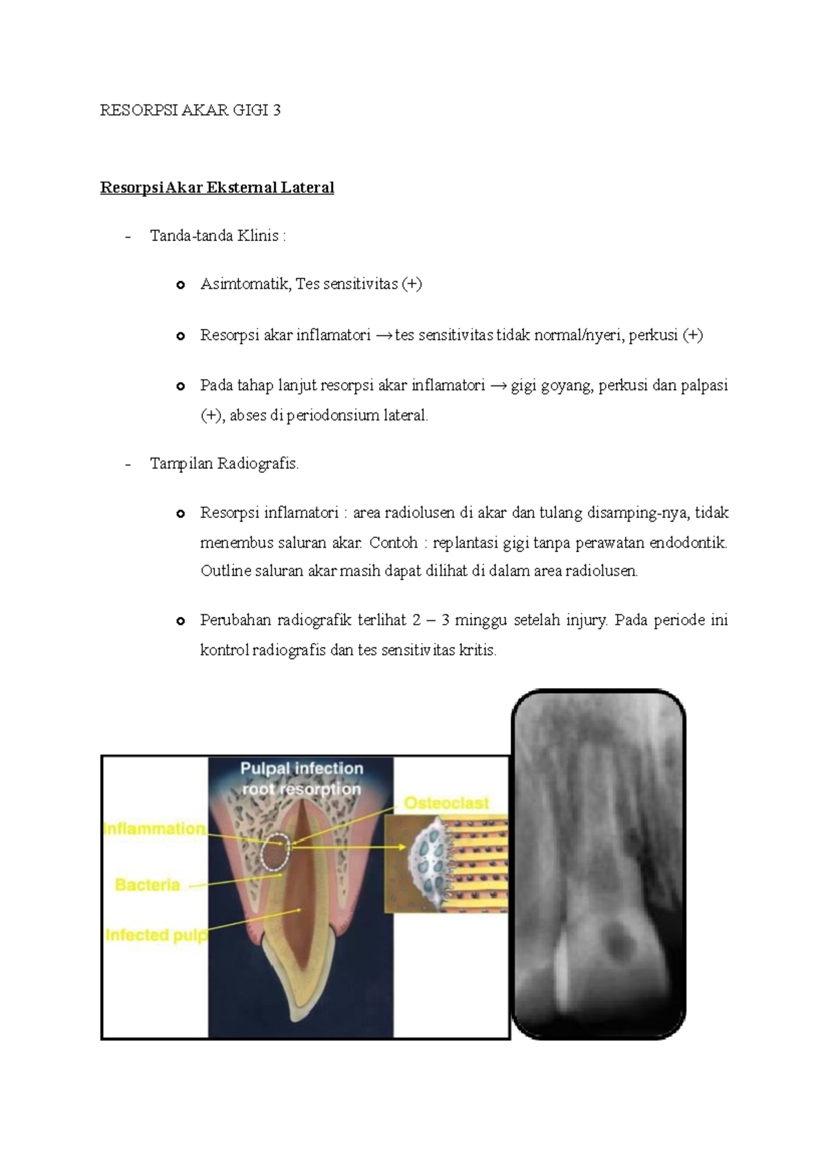 Resorpsi Akar Gigi 3 - RESORPSI AKAR GIGI 3 Resorpsi Akar Eksternal ...