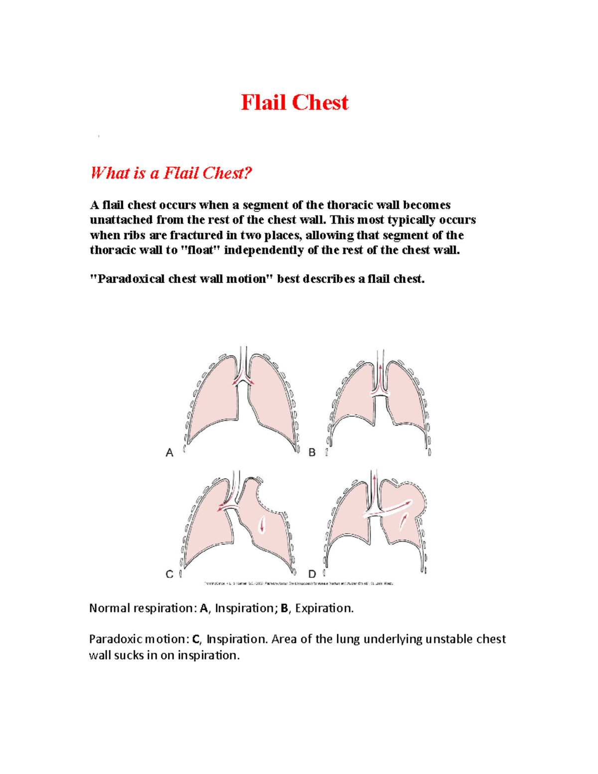 Flail Chest - Informational - Flail Chest What Is A Flail Chest? A ...