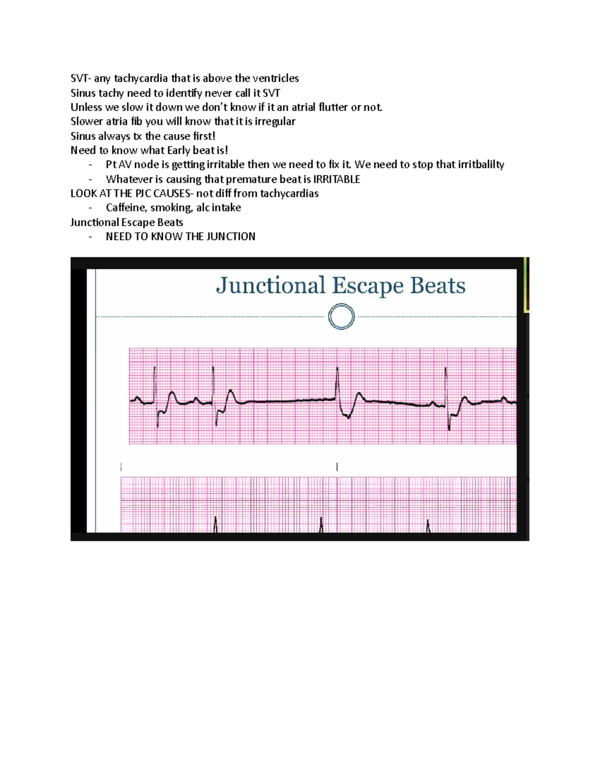 Practice EXAM Arrthymias NOTES - SVT- any tachycardia that is above the ...