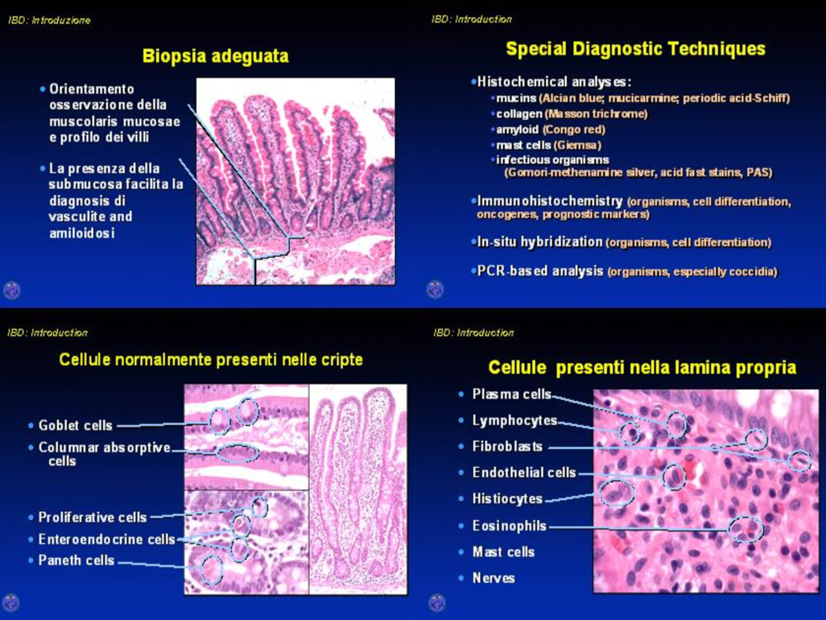 Appunti Su Malattie Infiammatorie Croniche Intestinali (MICI ...