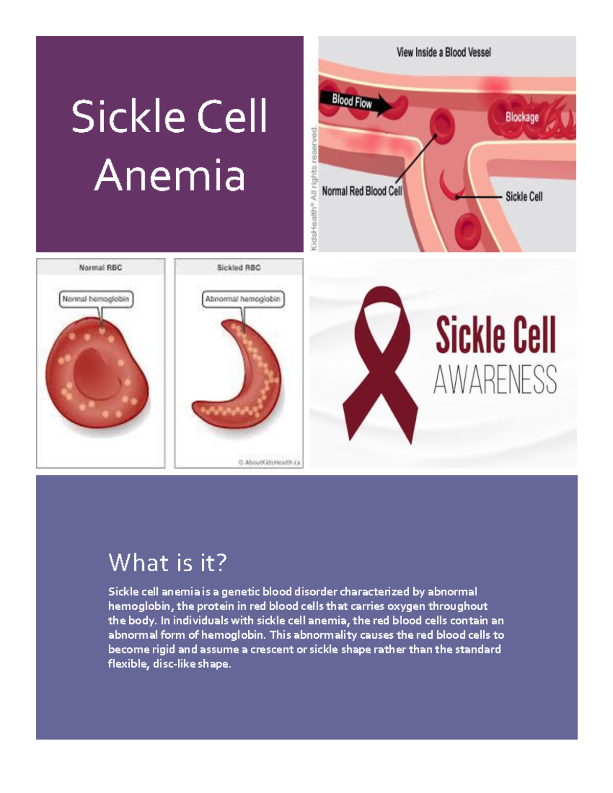 Sickle Cell Anemia infographic - Sickle Cell Anemia What is it? Sickle ...