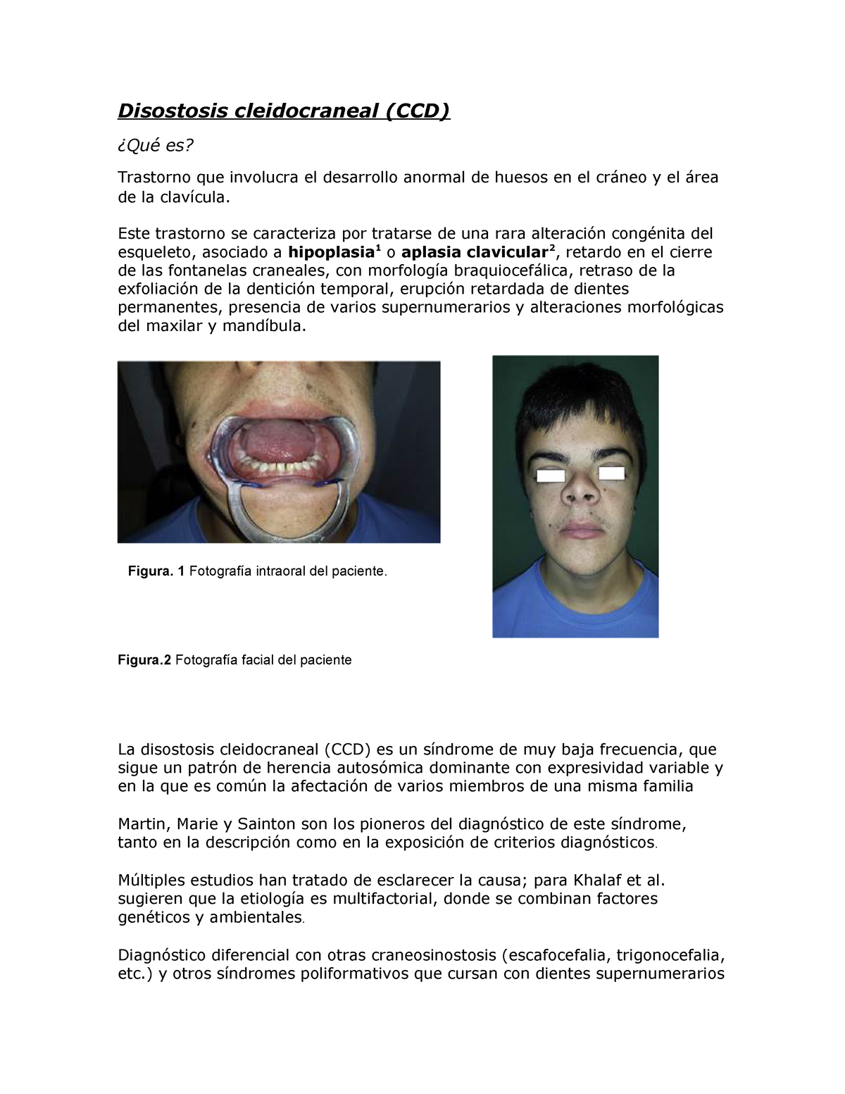 dientes de disostosis cleidocraneal