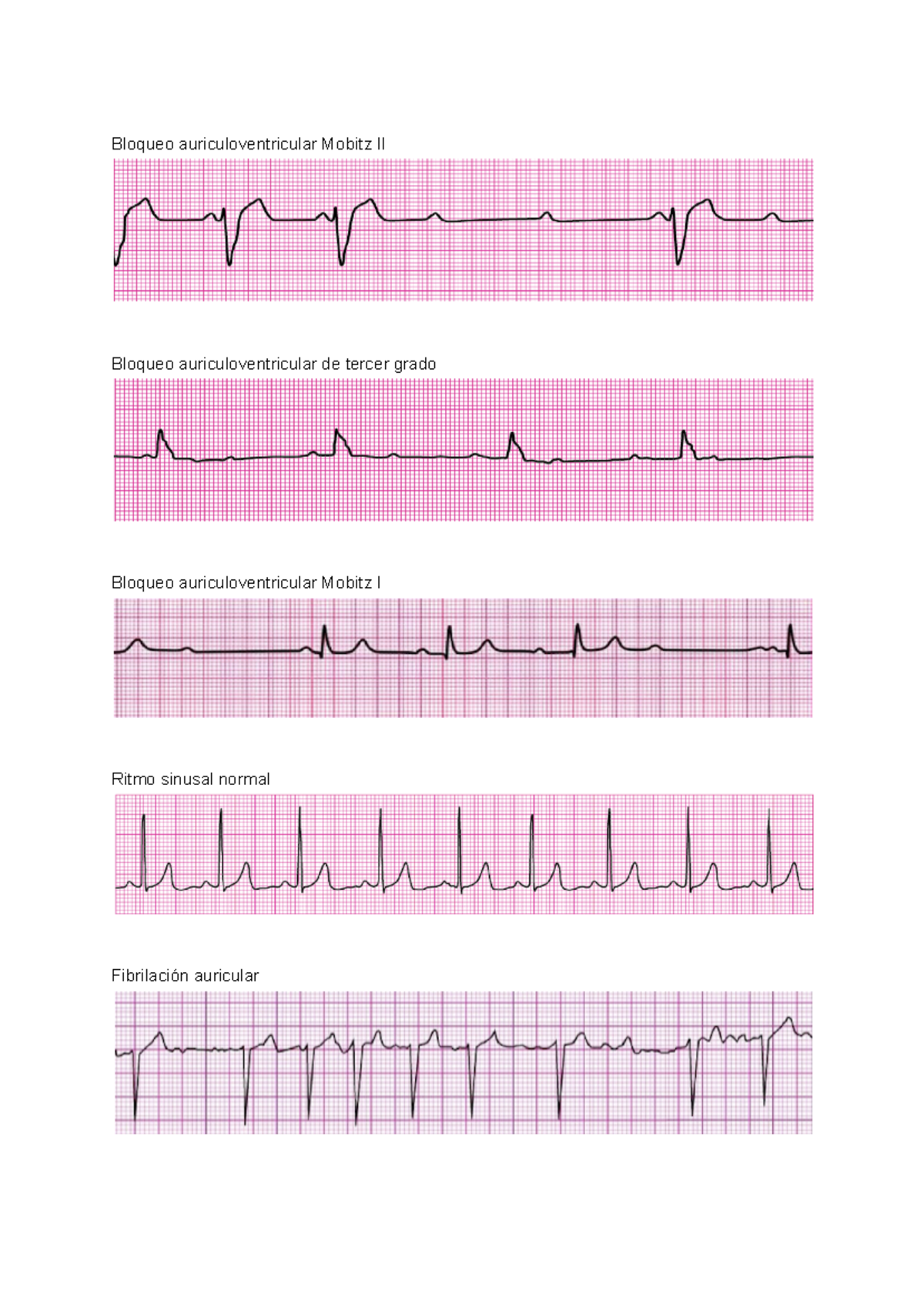 ACLS - ACLS - Bloqueo auriculoventricular Mobitz II Bloqueo ...