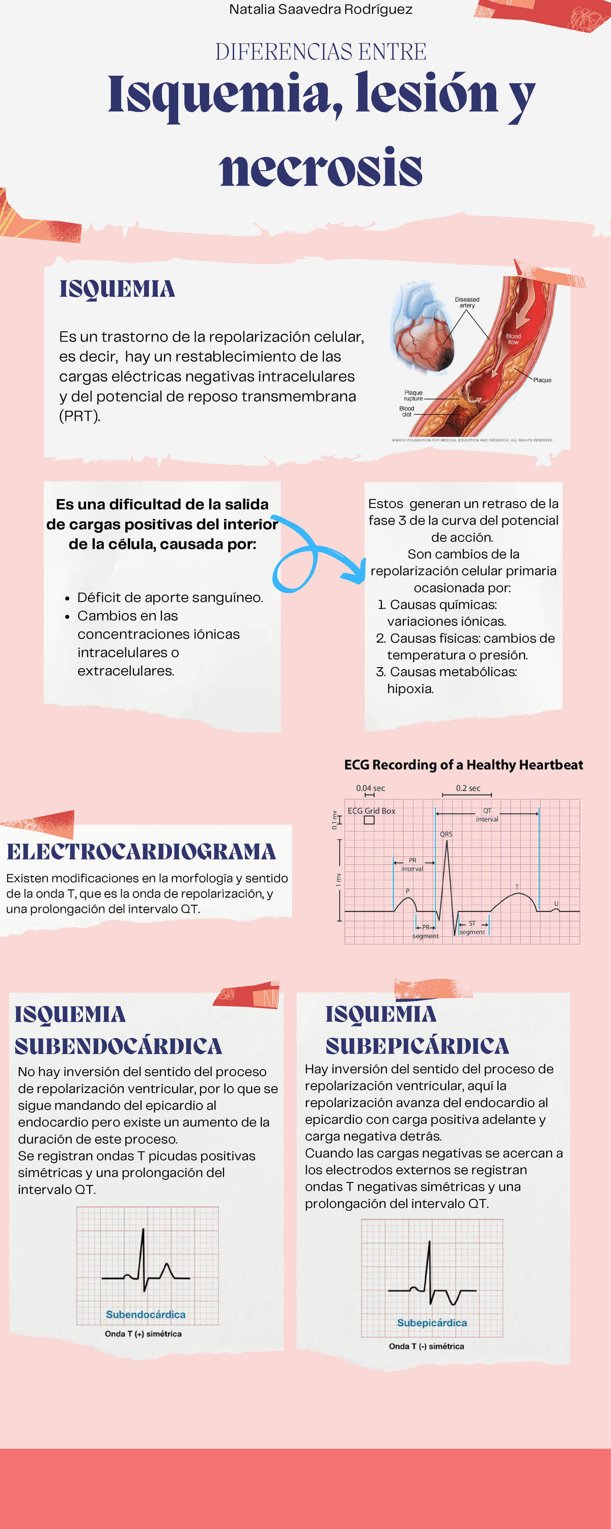 Diferencias Entre Isquemia Lesi N Y Necrosis Ekg Isquemia Lesi N Y Necrosis Diferencias