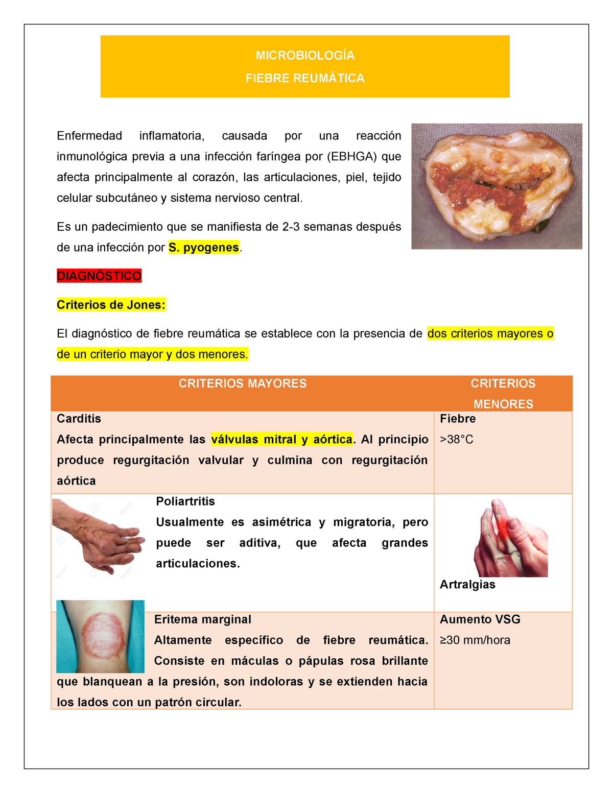 Fiebre Reumatica Generalidades Clínica Diagnostico Y Tratamiento